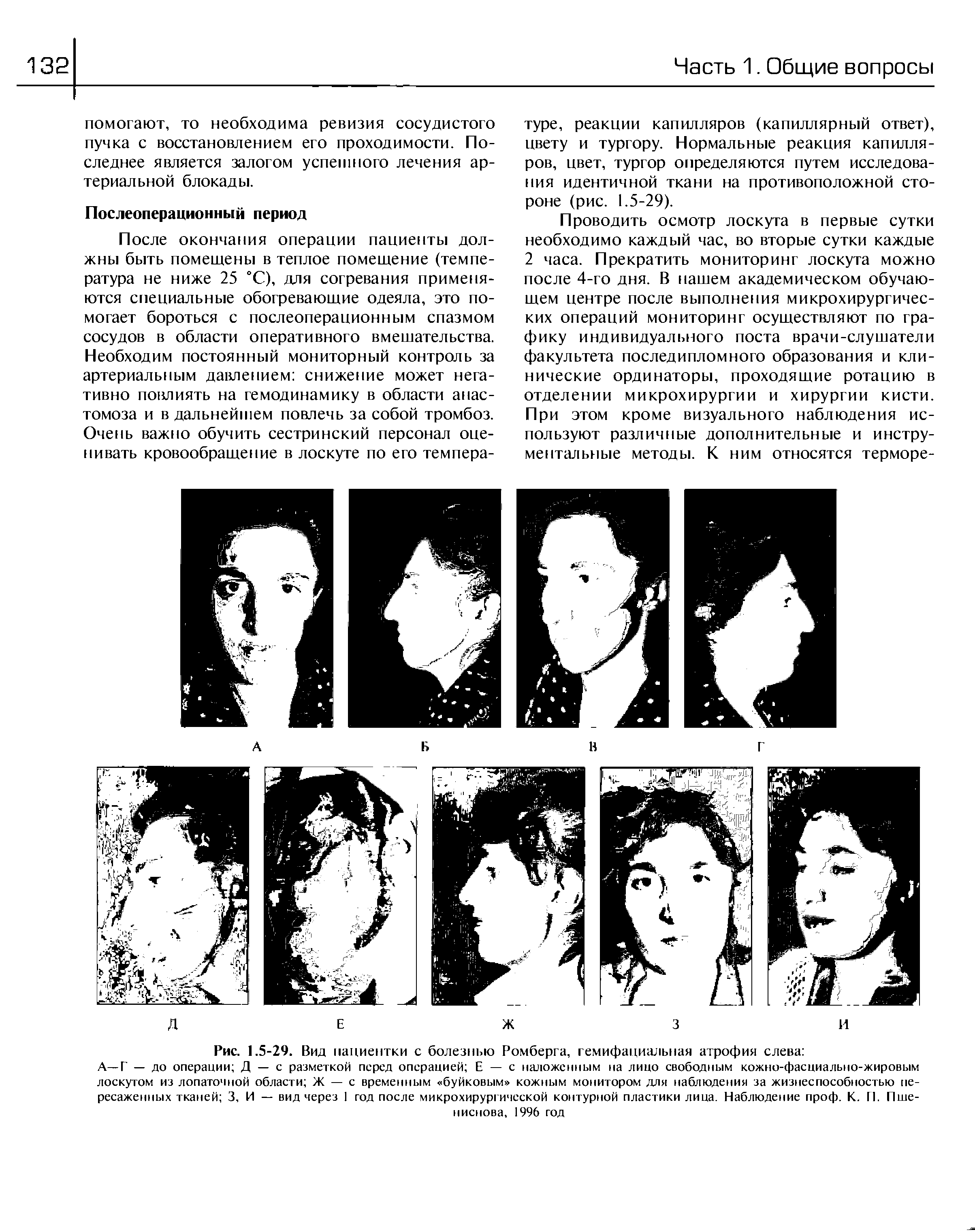 Рис. 1.5-29. Вид пациентки с болезнью Ромберга, гемифациальная атрофия слева ...