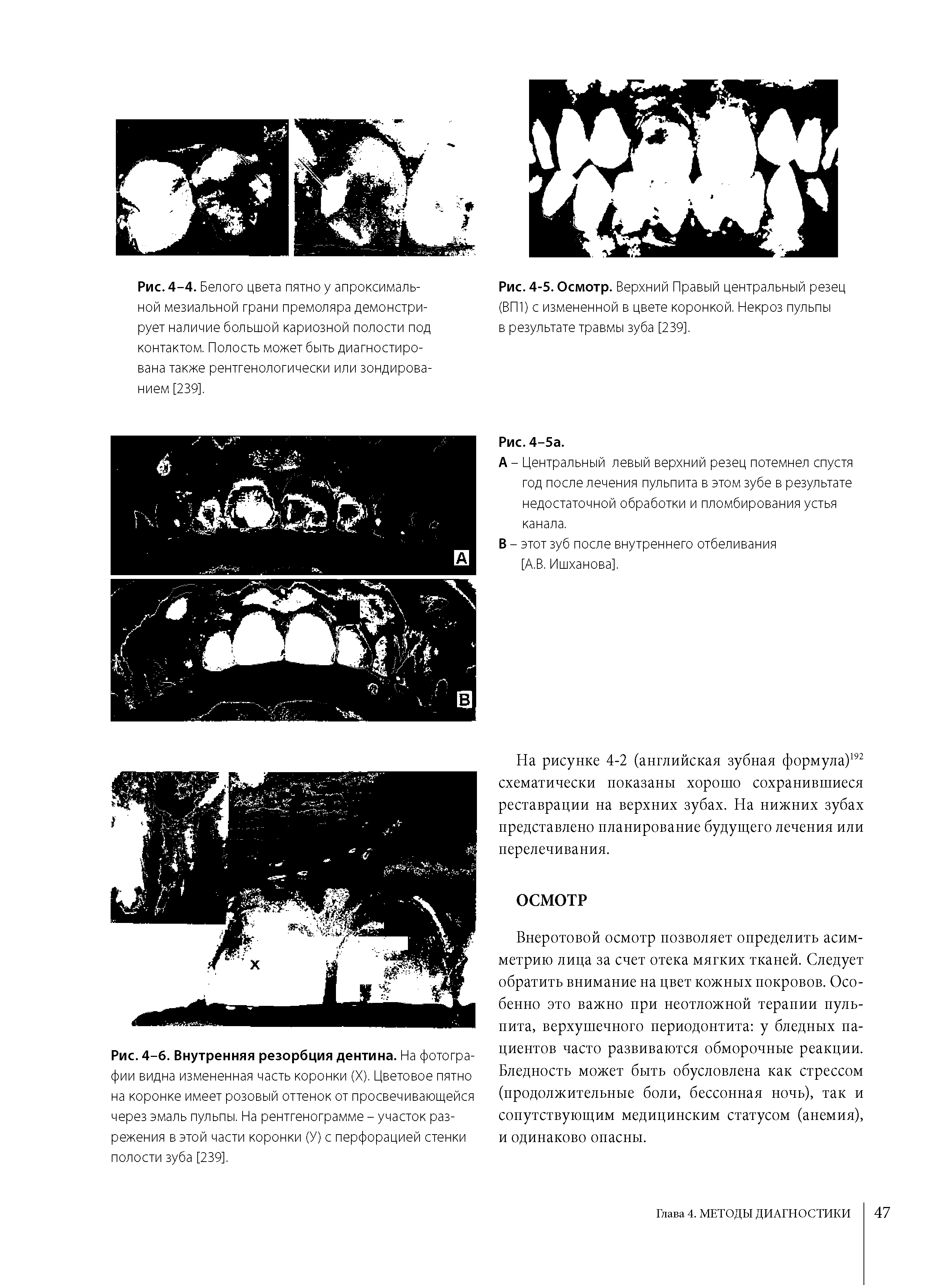 Рис. 4-5. Осмотр. Верхний Правый центральный резец (ВП1) с измененной в цвете коронкой. Некроз пульпы в результате травмы зуба [239].