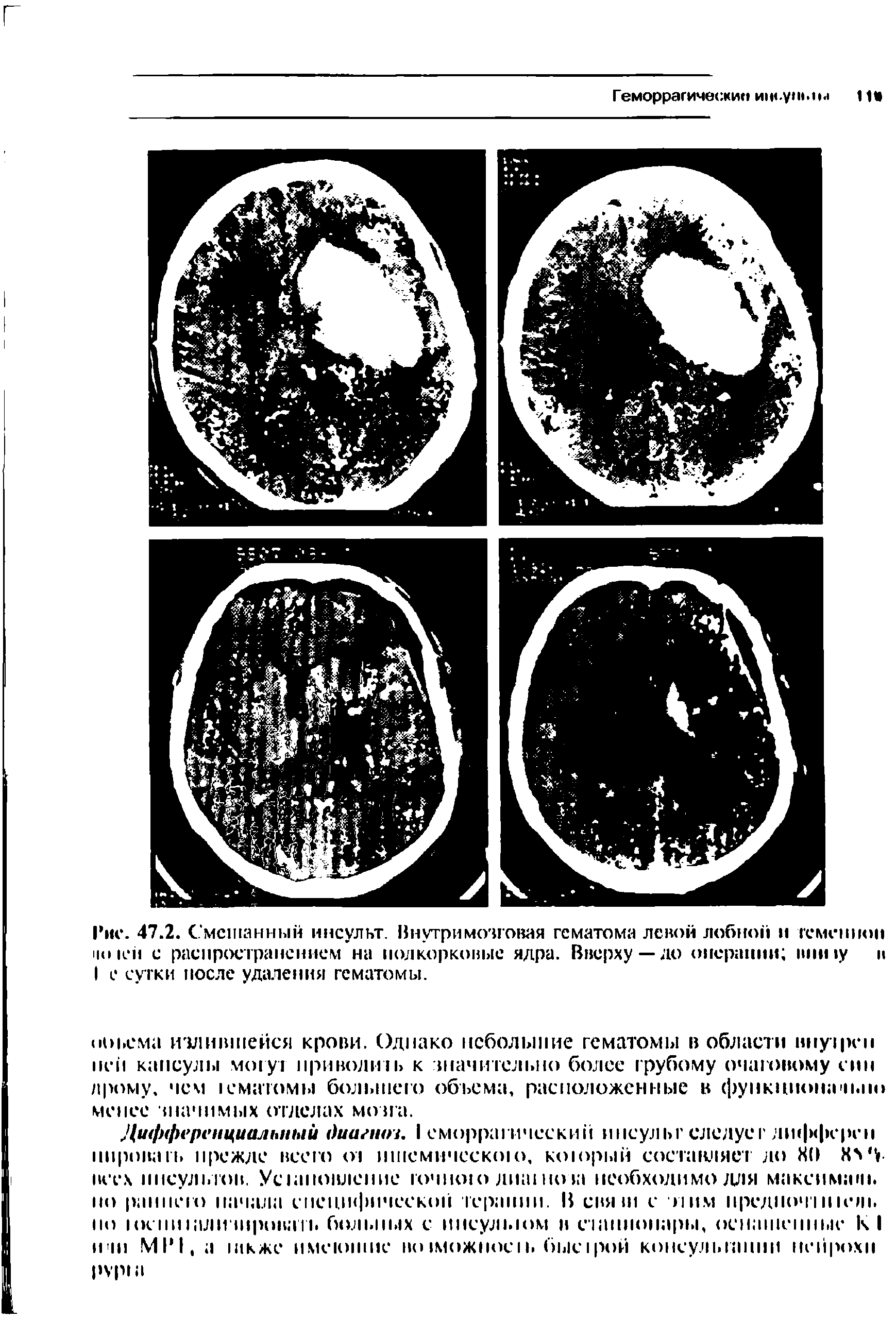 Рис. 47.2. Смешанный инсульт. Внутримозговая гематома левой лобной и геменнон иок й с распространением на подкорковые ядра. Вверху —до операции шипу и I с сутки после удаления гематомы.