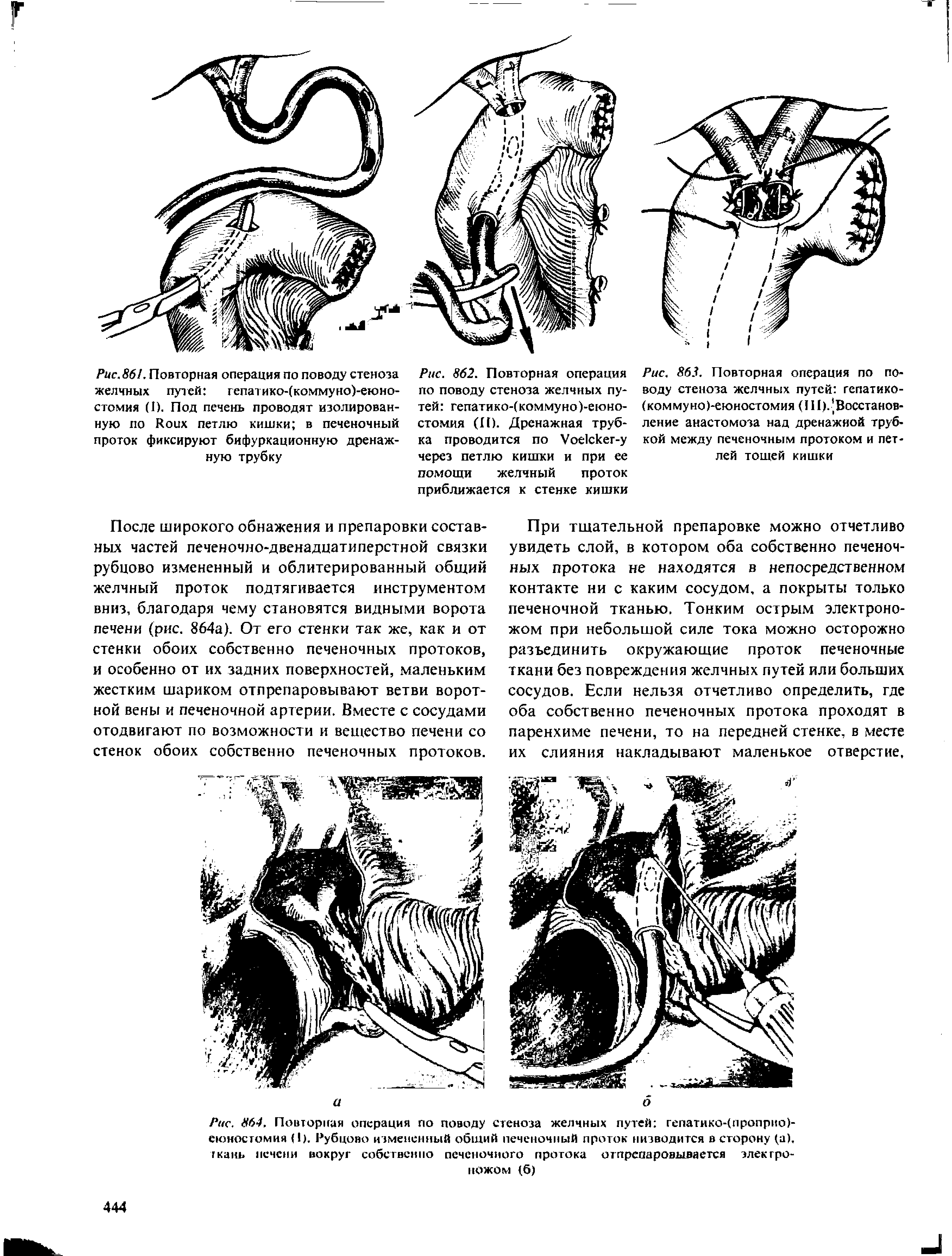 Рис. 86I. Повторная операция по поводу стеноза желчных путей гепатико-(коммуно)-еюно-стомия (1). Под печень проводят изолированную по R петлю кишки в печеночный проток фиксируют бифуркационную дренажную трубку...