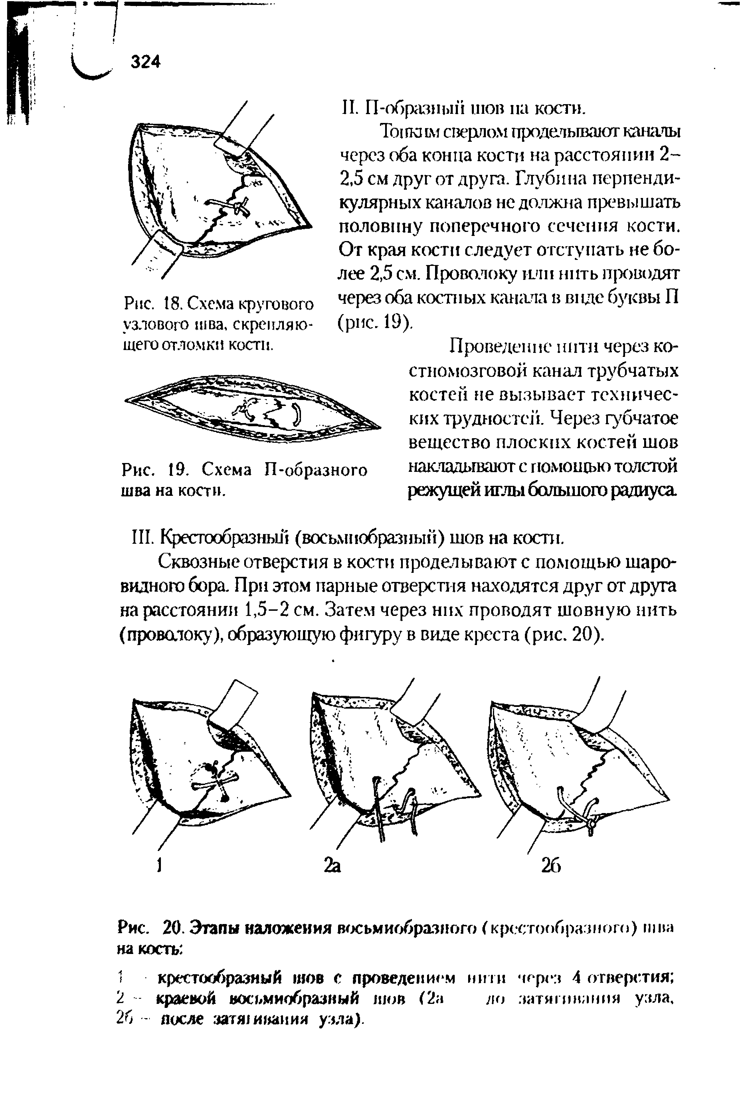 Рис. 19. Схема П-образного накладывают с помощью толстой шва на кости. режущей иглы большого радиуса...