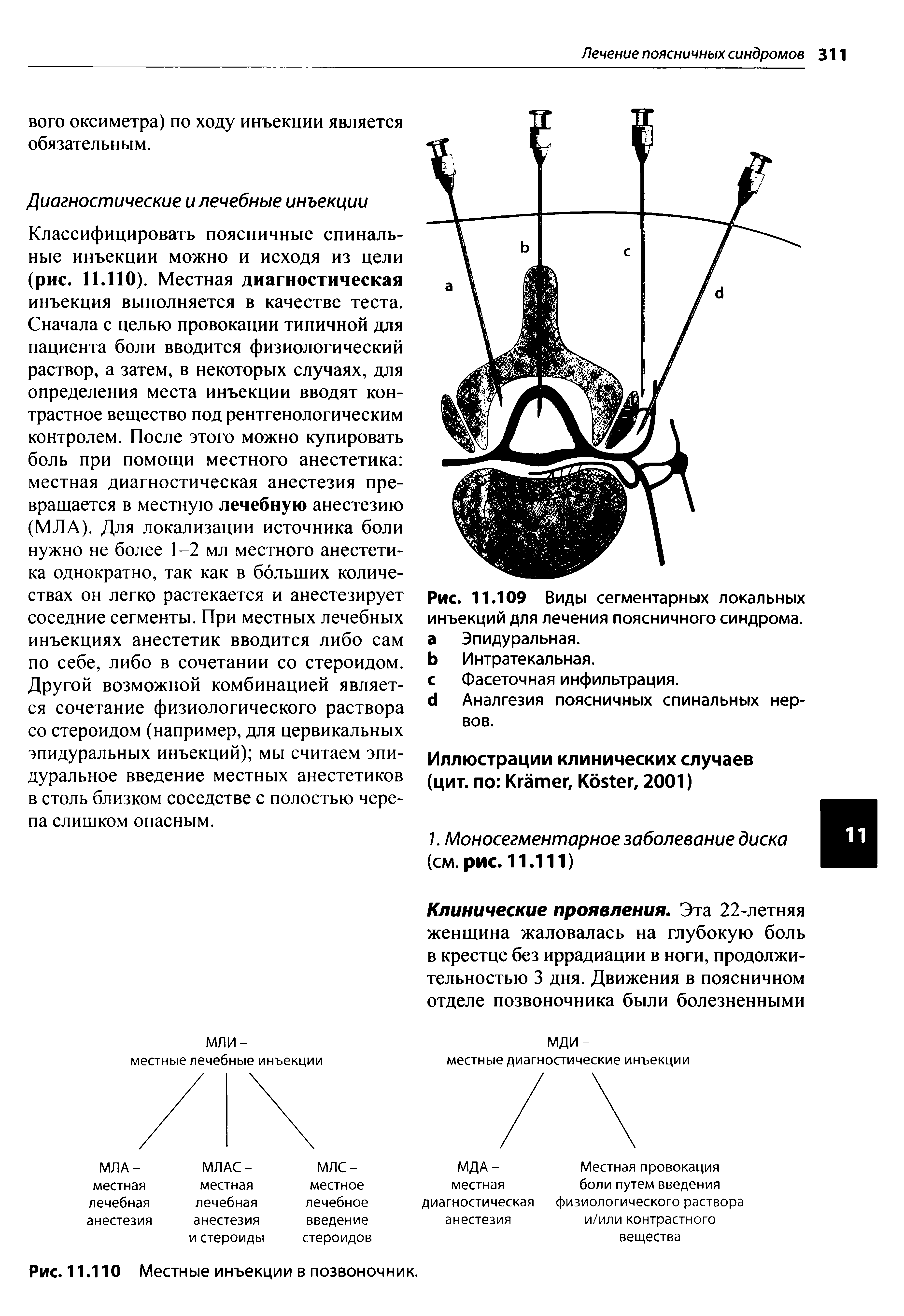 Рис. 11.109 Виды сегментарных локальных инъекций для лечения поясничного синдрома, а Эпидуральная.