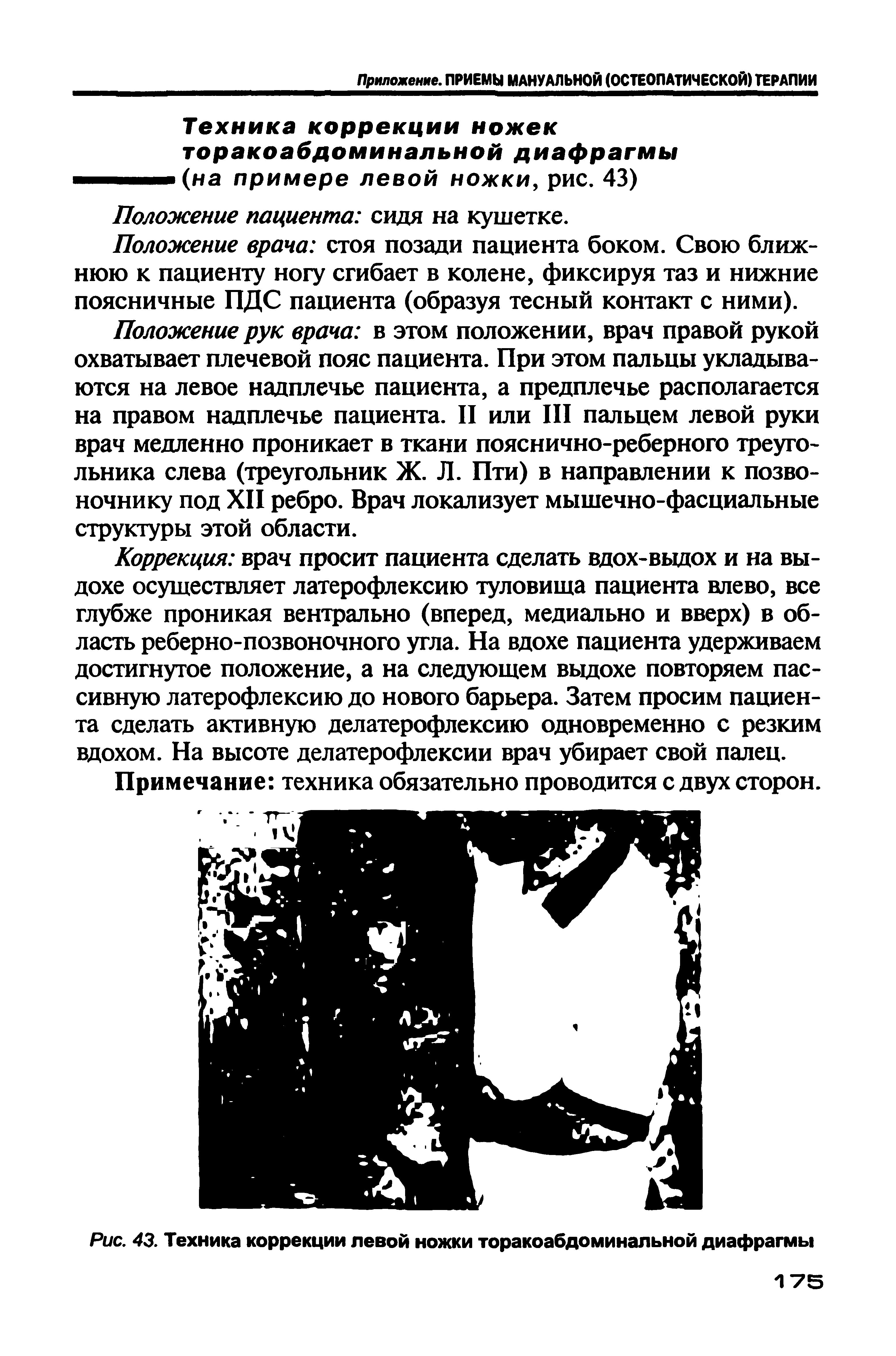 Рис. 43. Техника коррекции левой ножки торакоабдоминальной диафрагмы...