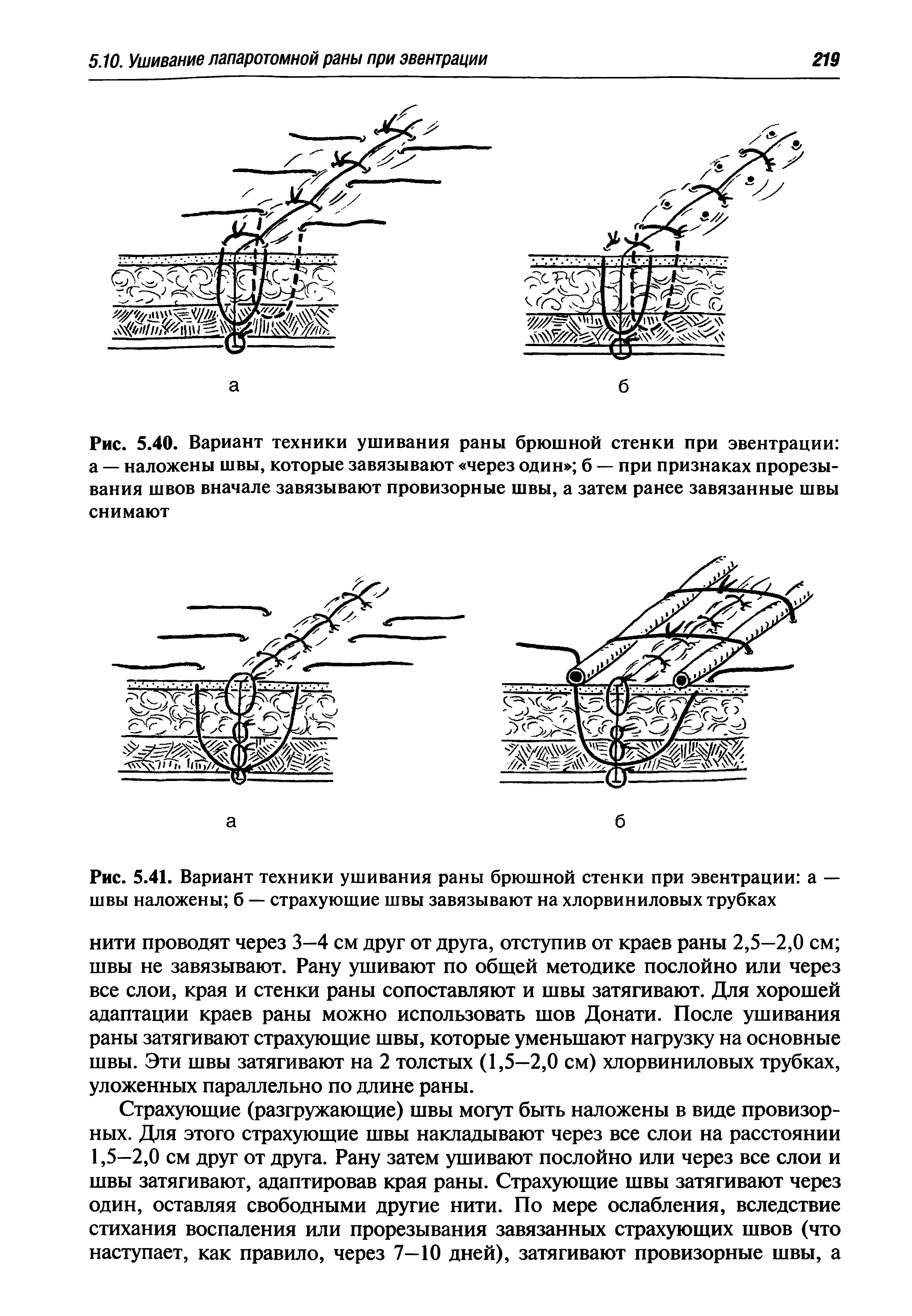 Рис. 5.41. Вариант техники ушивания раны брюшной стенки при эвентрации а — швы наложены б — страхующие швы завязывают на хлорвиниловых трубках...