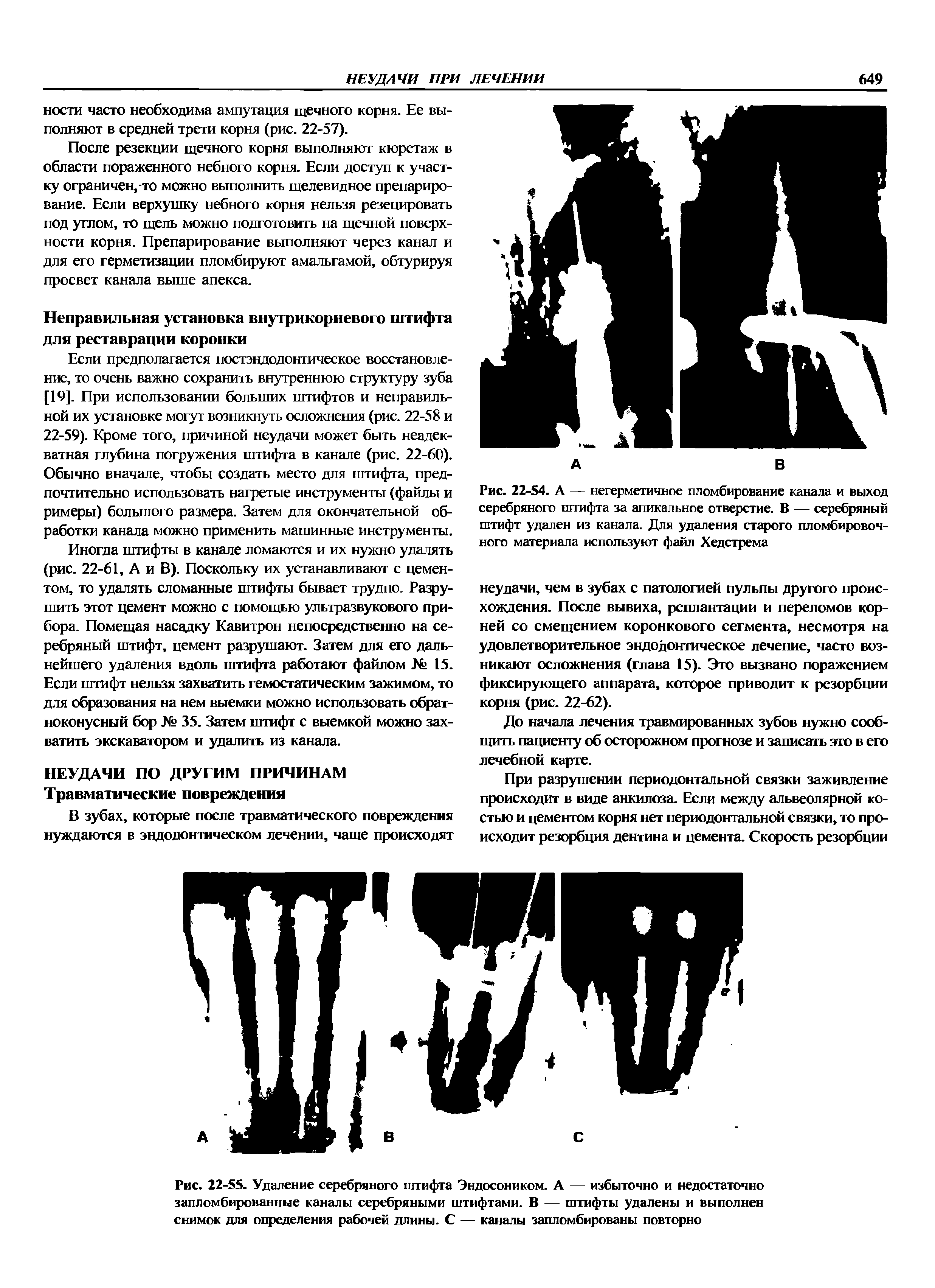 Рис. 22-54. А — негерметичное пломбирование канала и выход серебряного штифта за апикальное отверстие. В — серебряный штифт удален из канала. Для удаления старого пломбировочного материала используют файл Хедстрема...