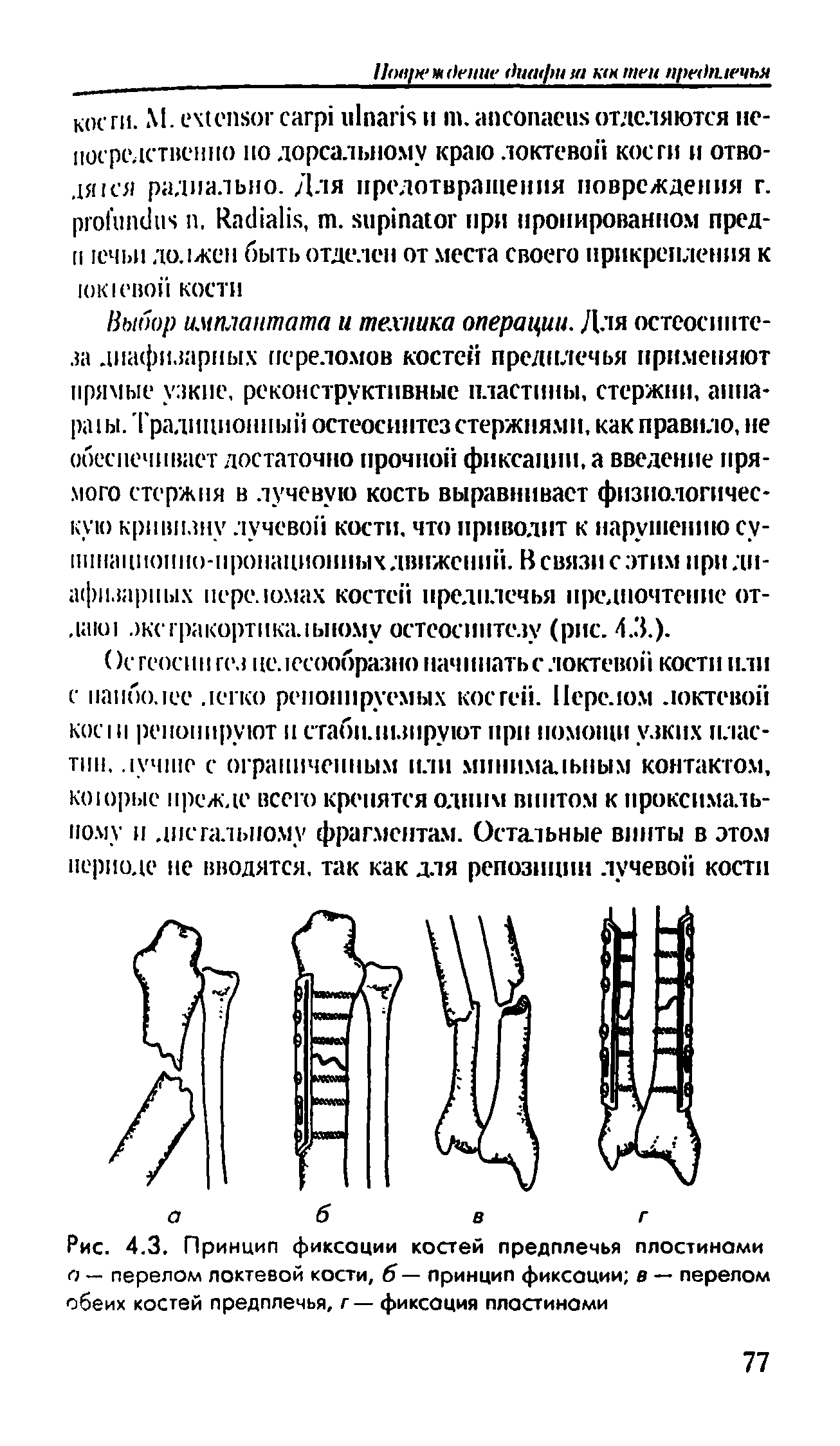 Рис. 4.3. Принцип фиксации костей предплечья плостинами а — перелом локтевой кости, 6— принцип фиксации в — перелом обеих костей предплечья, г — фиксация пластинами...