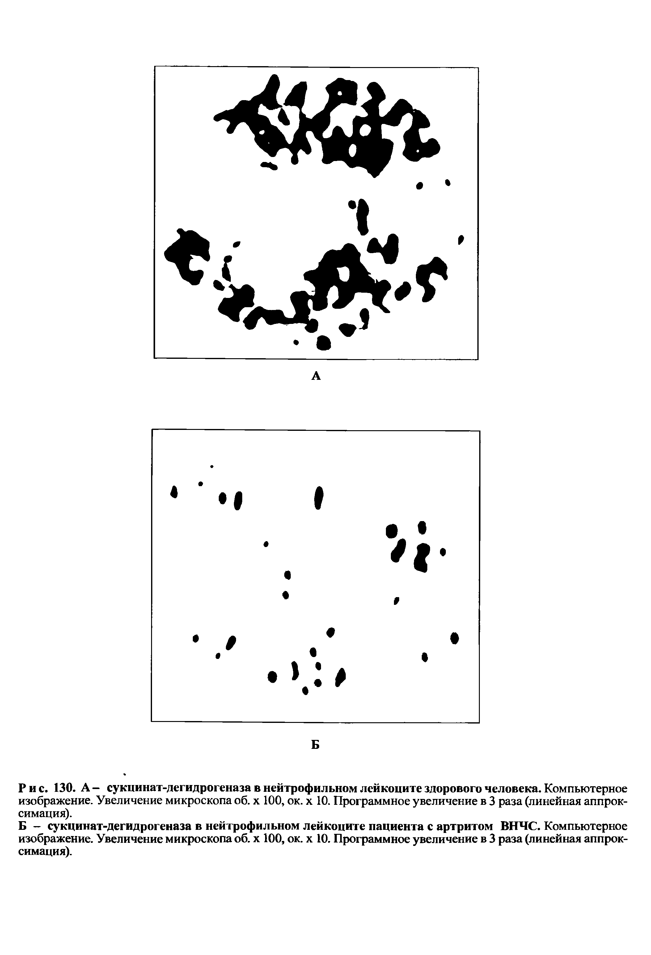 Рис. 130. А - сукцинат-дегидрогеназа в нейтрофильном лейкоците здорового человека. Компьютерное изображение. Увеличение микроскопа об. х 100, ок. х 10. Программное увеличение в 3 раза (линейная аппроксимация).
