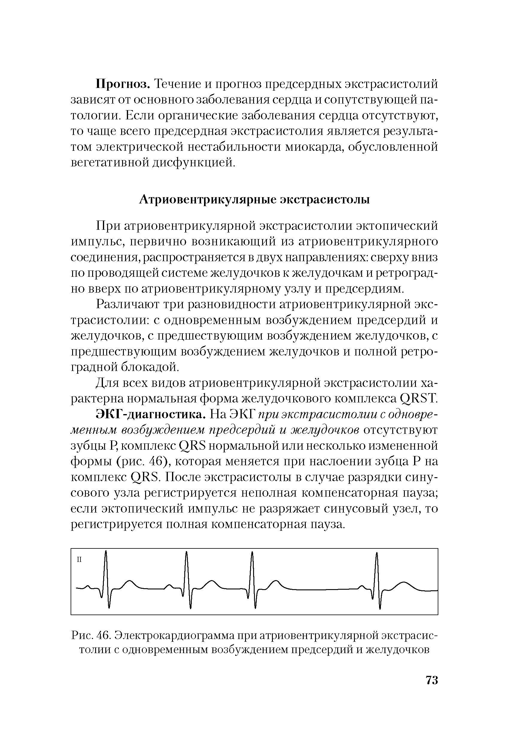 Рис. 46. Электрокардиограмма при атриовентрикулярной экстрасистолии с одновременным возбуждением предсердий и желудочков...