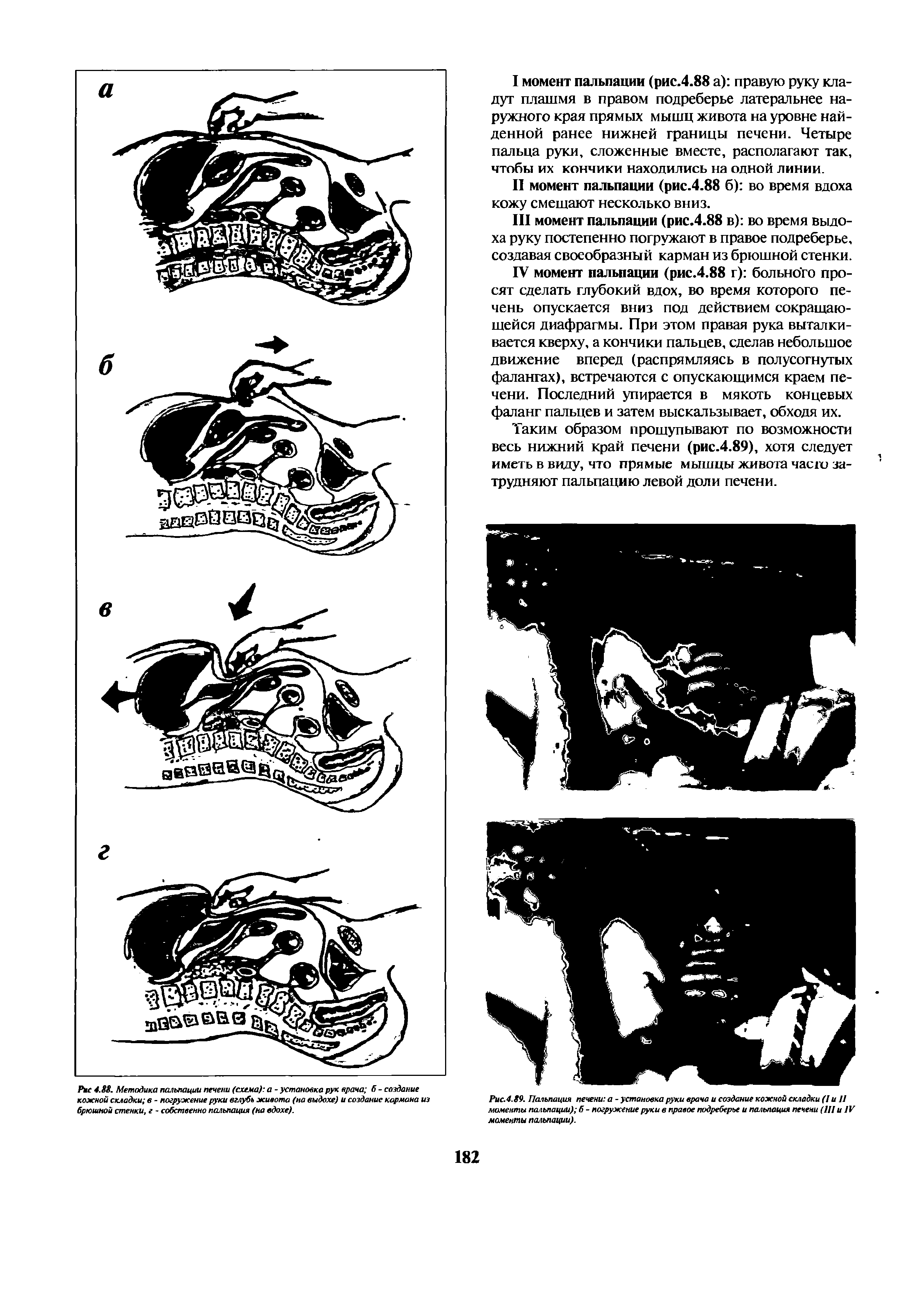 Рис.4.89. Пальпация печени а - установка руки врача и создание кожной складки (I и 11 моменты пальпации) б - погружение руки в правое подреберье и пальпация печени (111 и IV моменты пальпации).