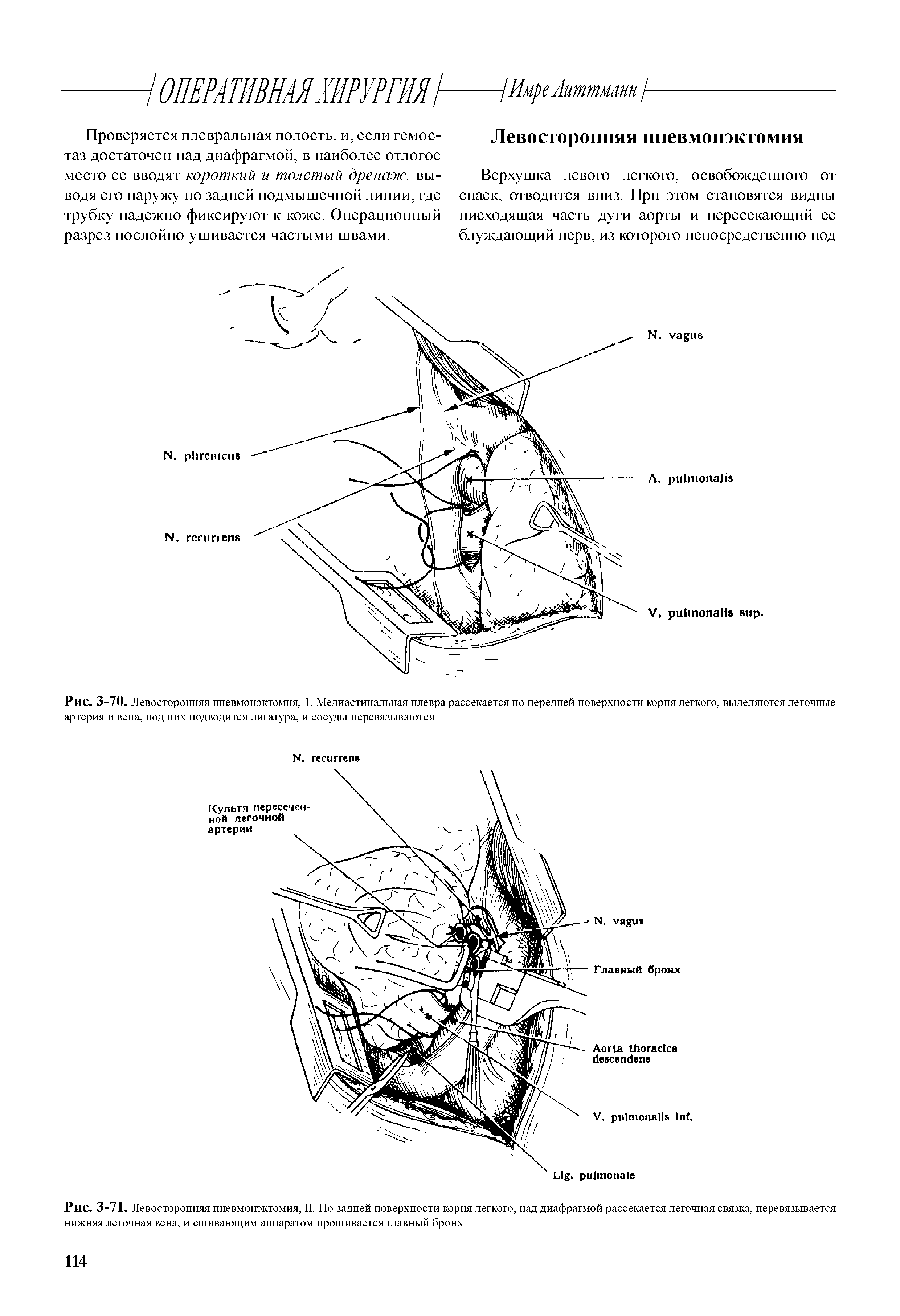 Рис. 3-70. Левосторонняя пневмонэктомия, 1. Медиастинальная плевра рассекается по передней поверхности корня легкого, выделяются легочные артерия и вена, под них подводится лигатура, и сосуды перевязываются...