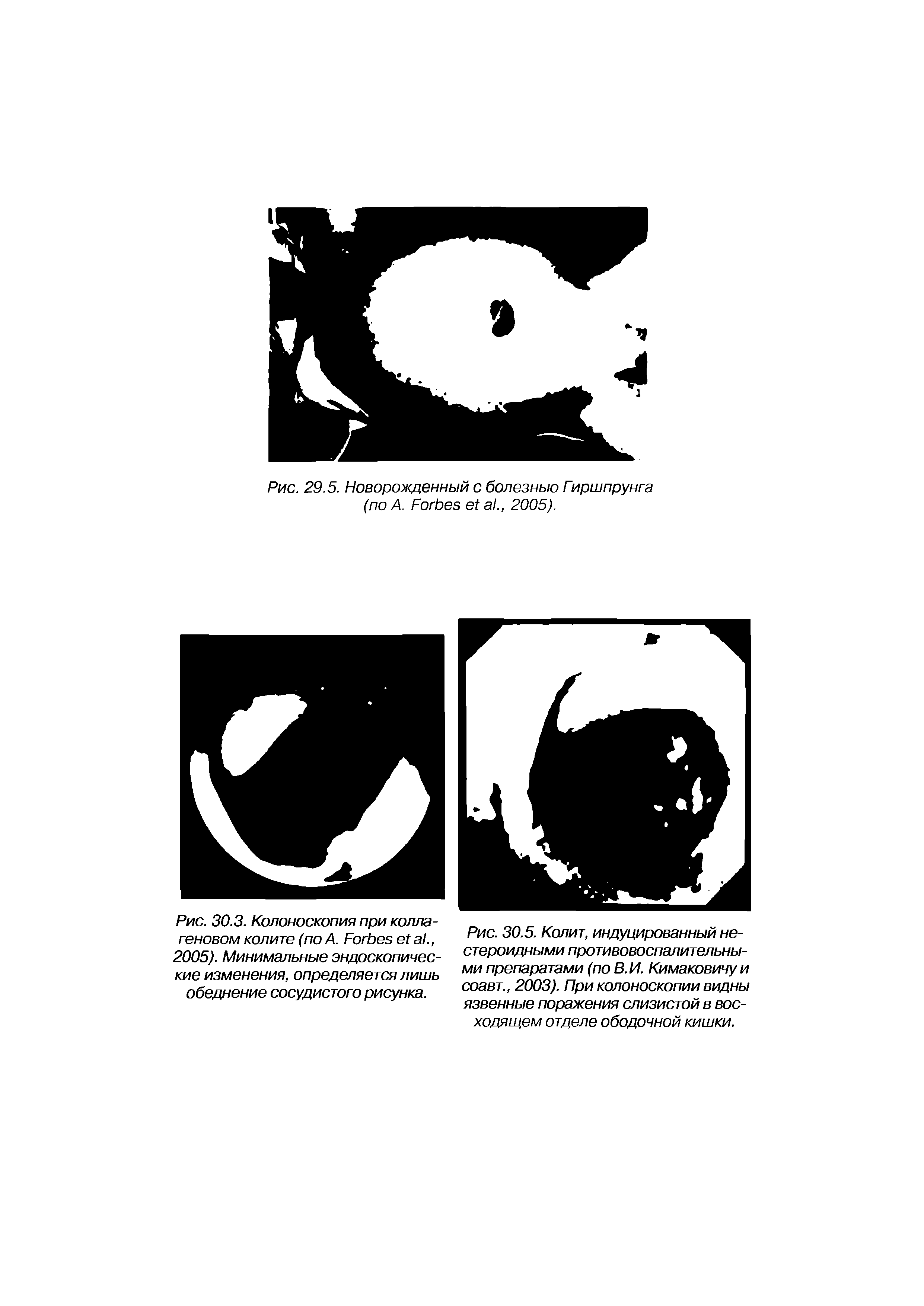 Рис. 30.3. Колоноскопия при коллагеновом колите (по А. F а ., 2005). Минимальные эндоскопические изменения, определяется лишь обеднение сосудистого рисунка.