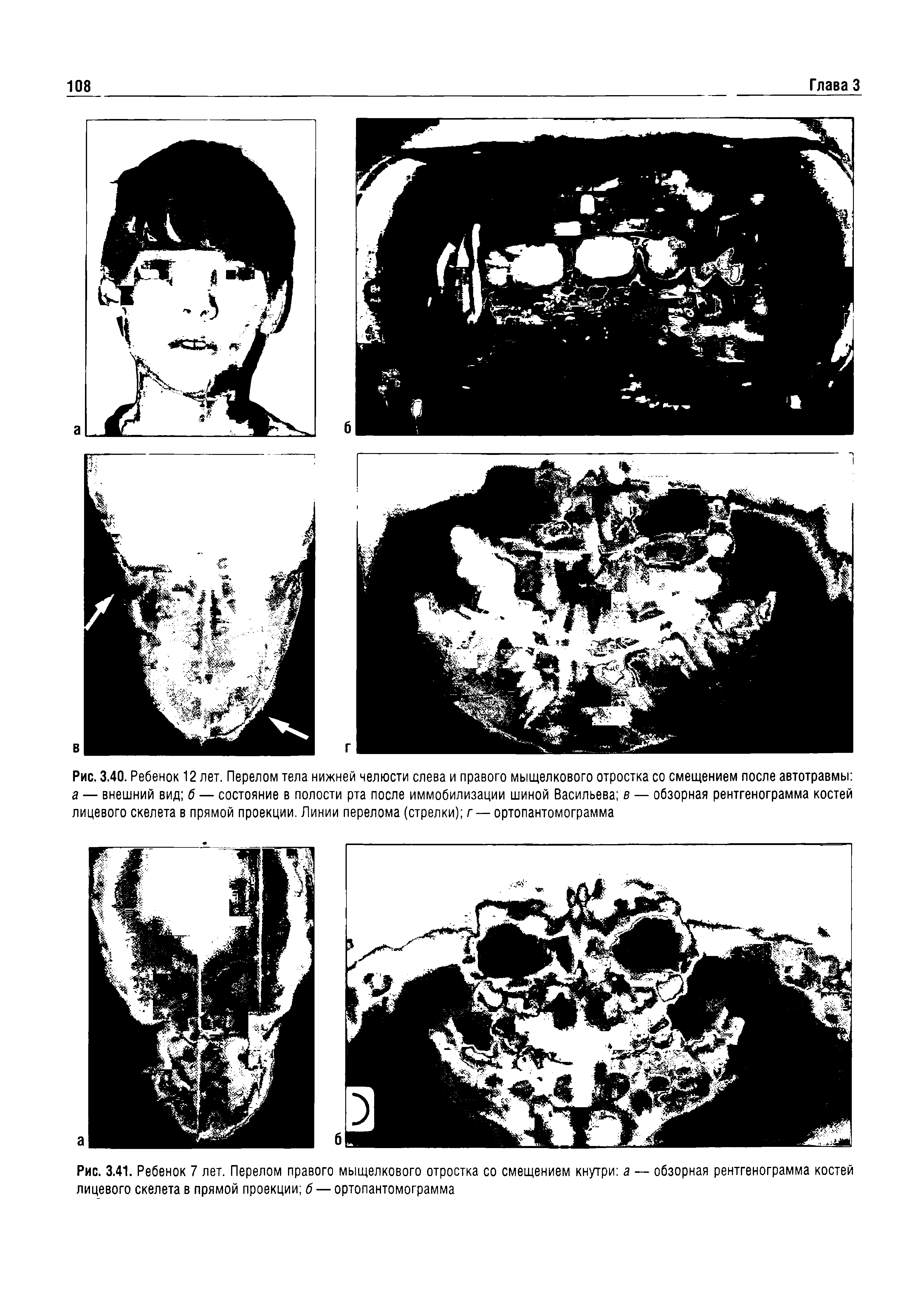 Рис. 3.41. Ребенок 7 лет. Перелом правого мыщелкового отростка со смещением кнутри а — обзорная рентгенограмма костей лицевого скелета в прямой проекции б — ортопантомограмма...