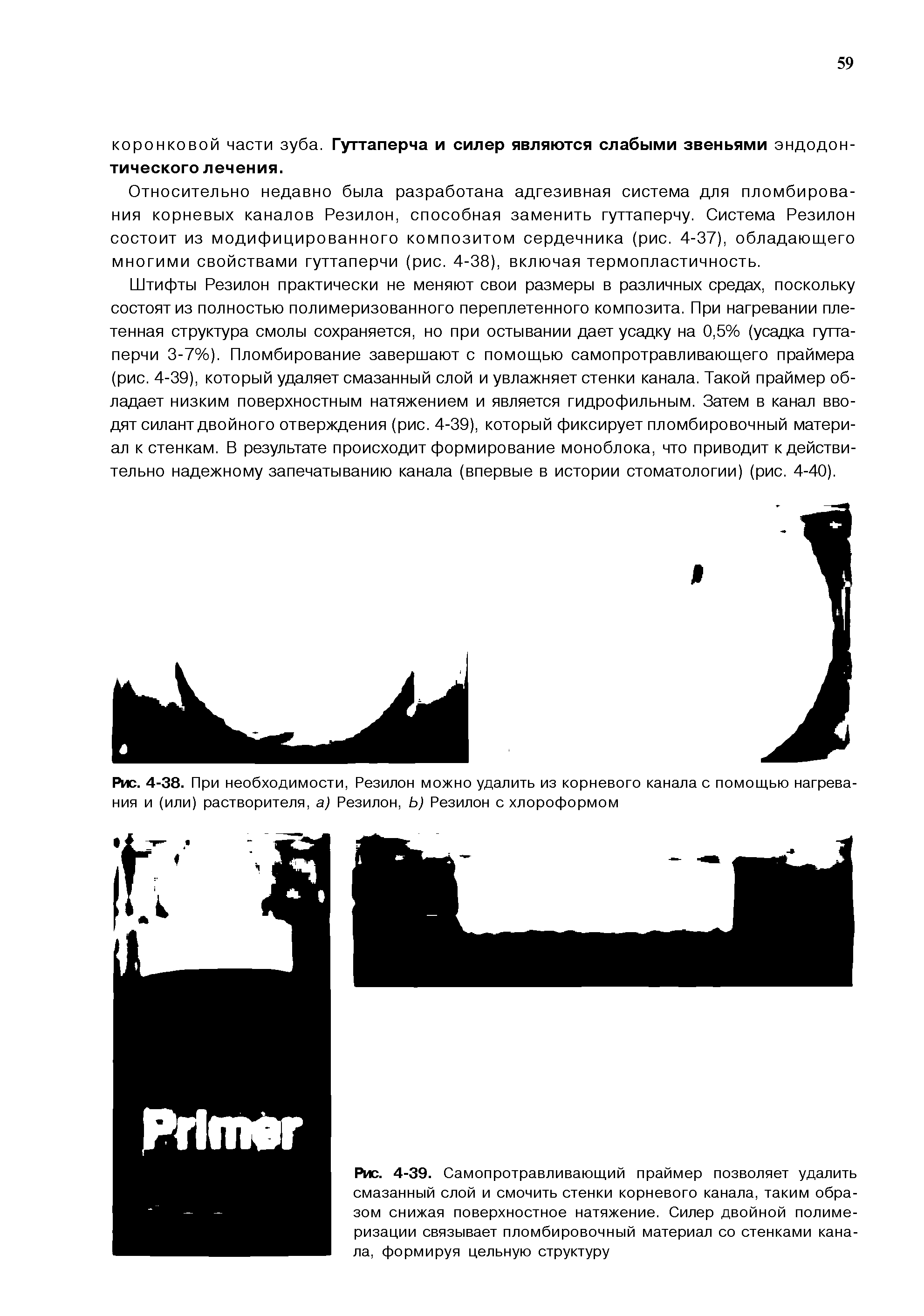 Рис. 4-39. Самопротравливающий праймер позволяет удалить смазанный слой и смочить стенки корневого канала, таким образом снижая поверхностное натяжение. Силер двойной полимеризации связывает пломбировочный материал со стенками канала, формируя цельную структуру...