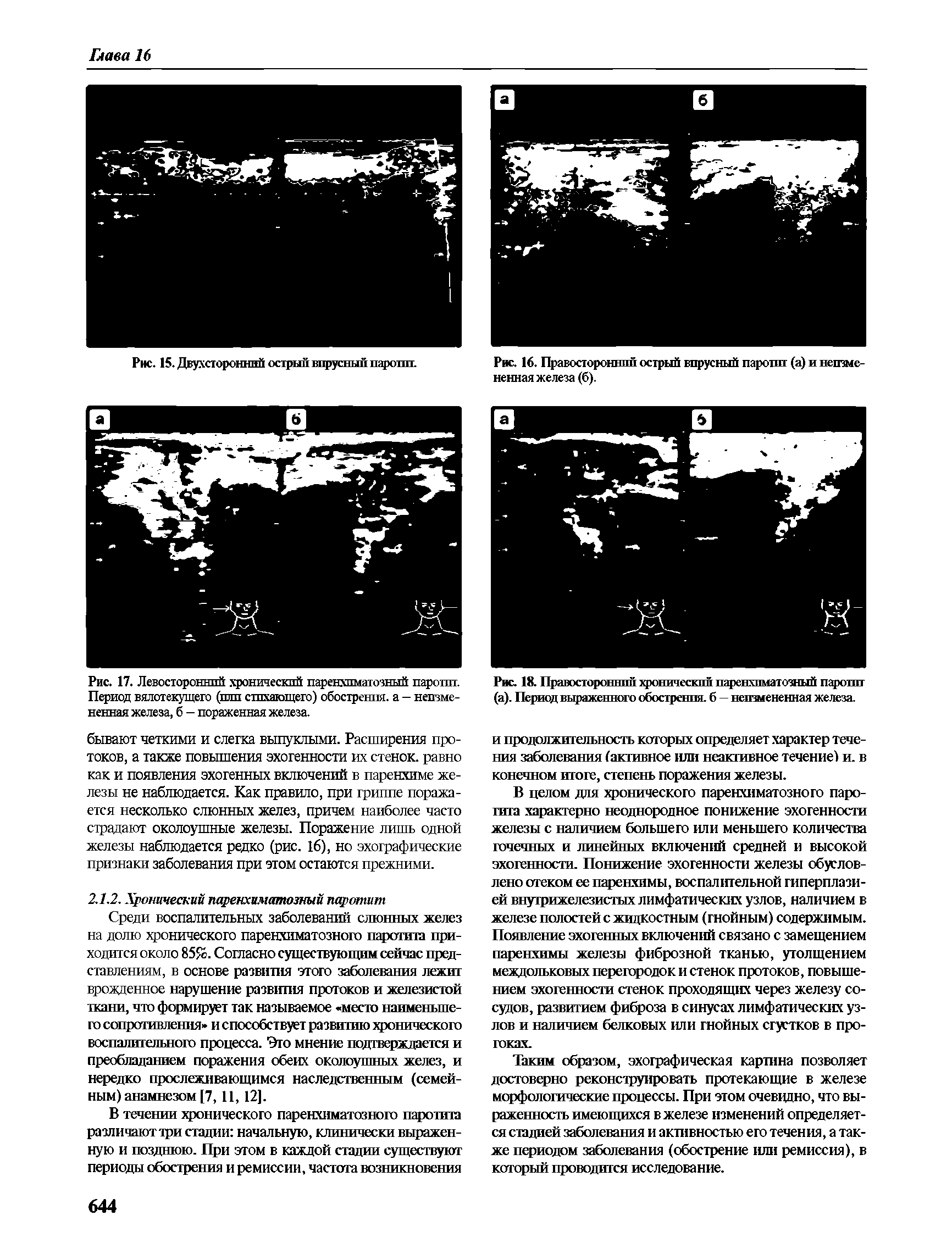 Рис. 18. Правосторонний хронический паренхиматозный паротит (а). Период выраженного обострения. 6 — неизмененная железа.