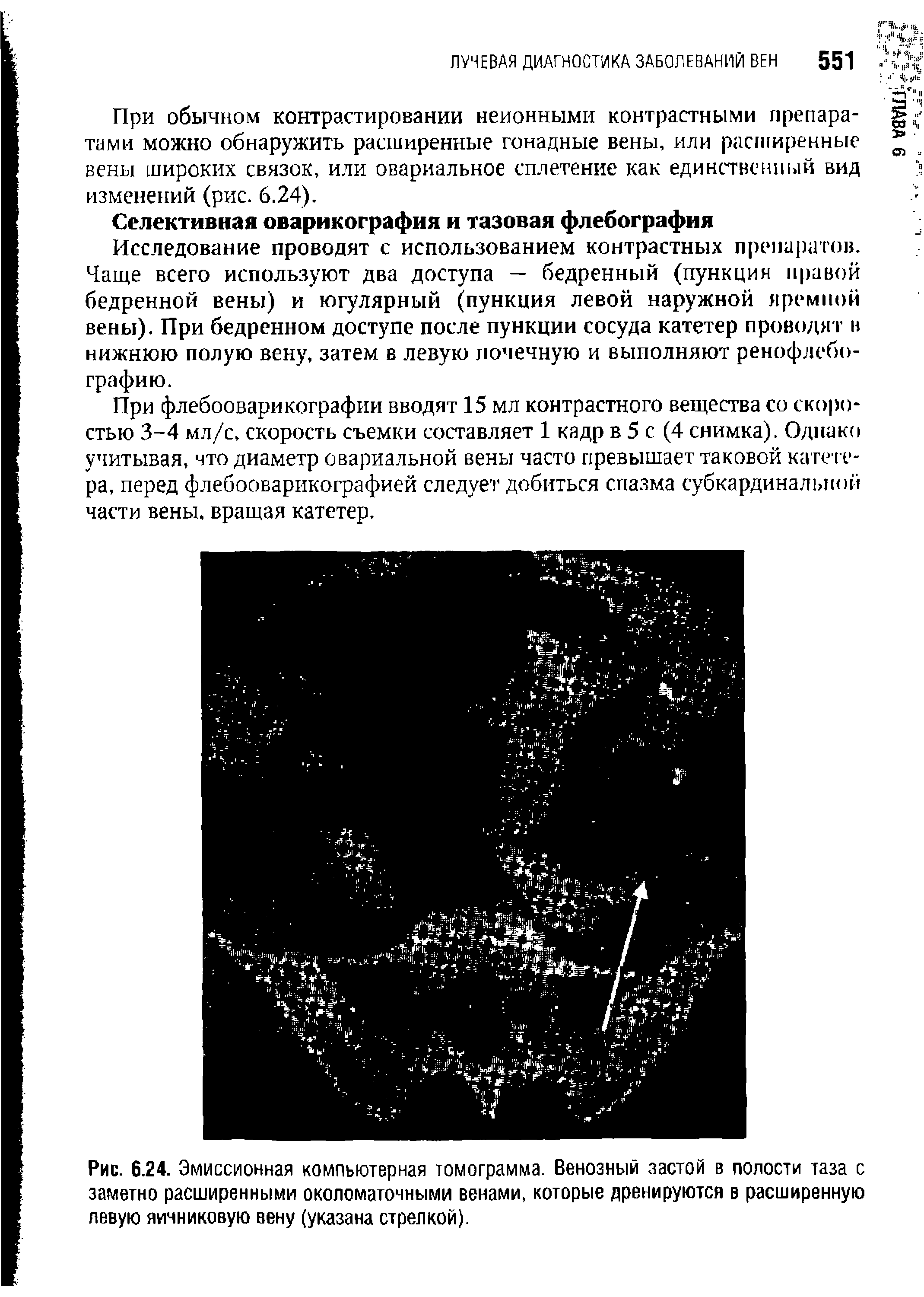 Рис. 6.24. Эмиссионная компьютерная томограмма. Венозный застой в полости таза с заметно расширенными околоматочными венами, которые дренируются в расширенную левую яичниковую вену (указана стрелкой).