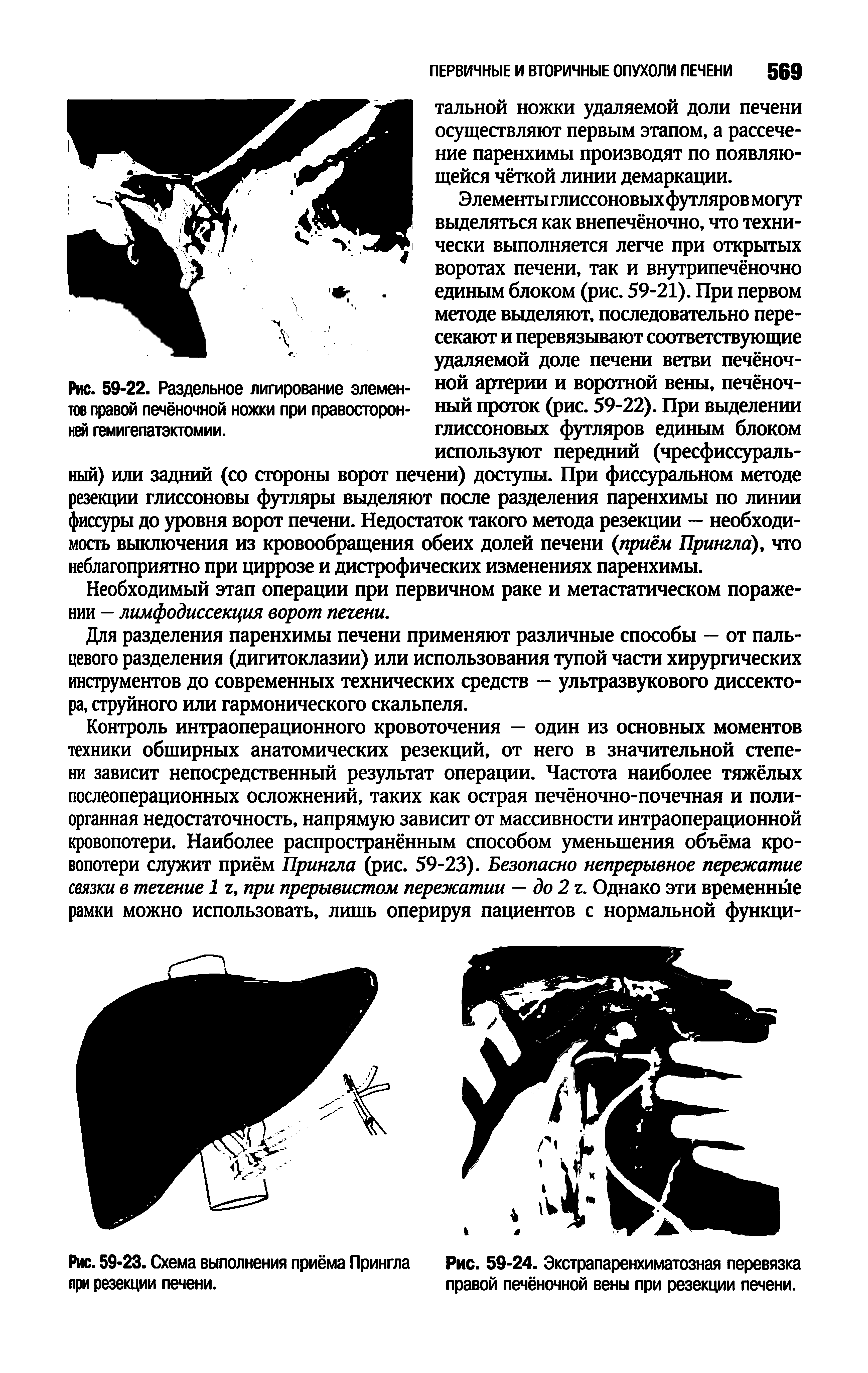 Рис. 59-22. Раздельное лигирование элемен- н°й артерии и воротной вены, печёноч-тов правой печёночной ножки при правосторон- ный проток (рис. 59-22). При выделении ней гемигепатэктомии. глиссоновых футляров единым блоком...