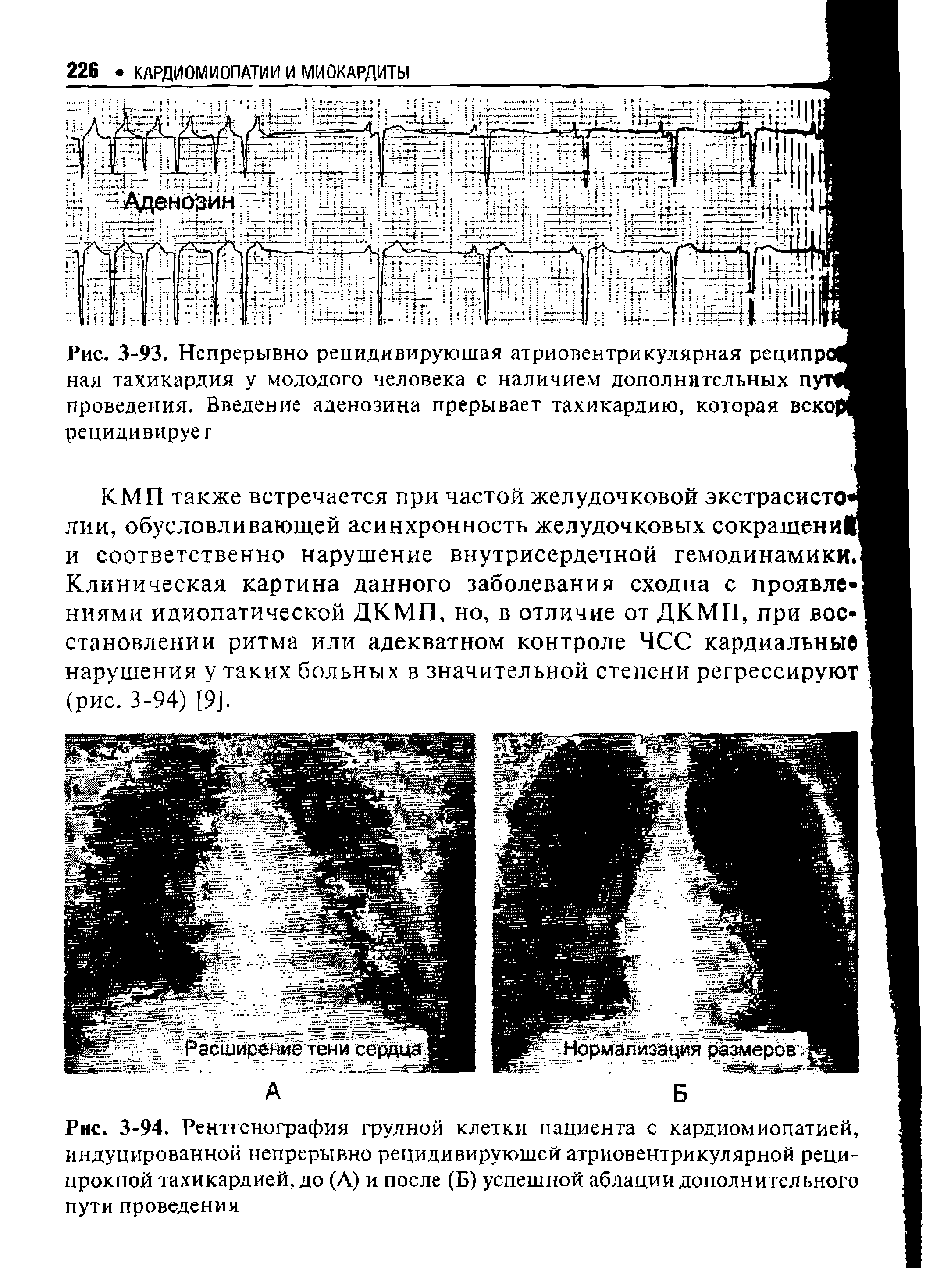 Рис. 3-94. Рентгенография грудной клетки пациента с кардиомиопатией, индуцированной непрерывно рецидивирующей атриовентрикулярной реципрокной тахикардией, до (А) и после (Б) успешной аблации дополнительного пути проведения...