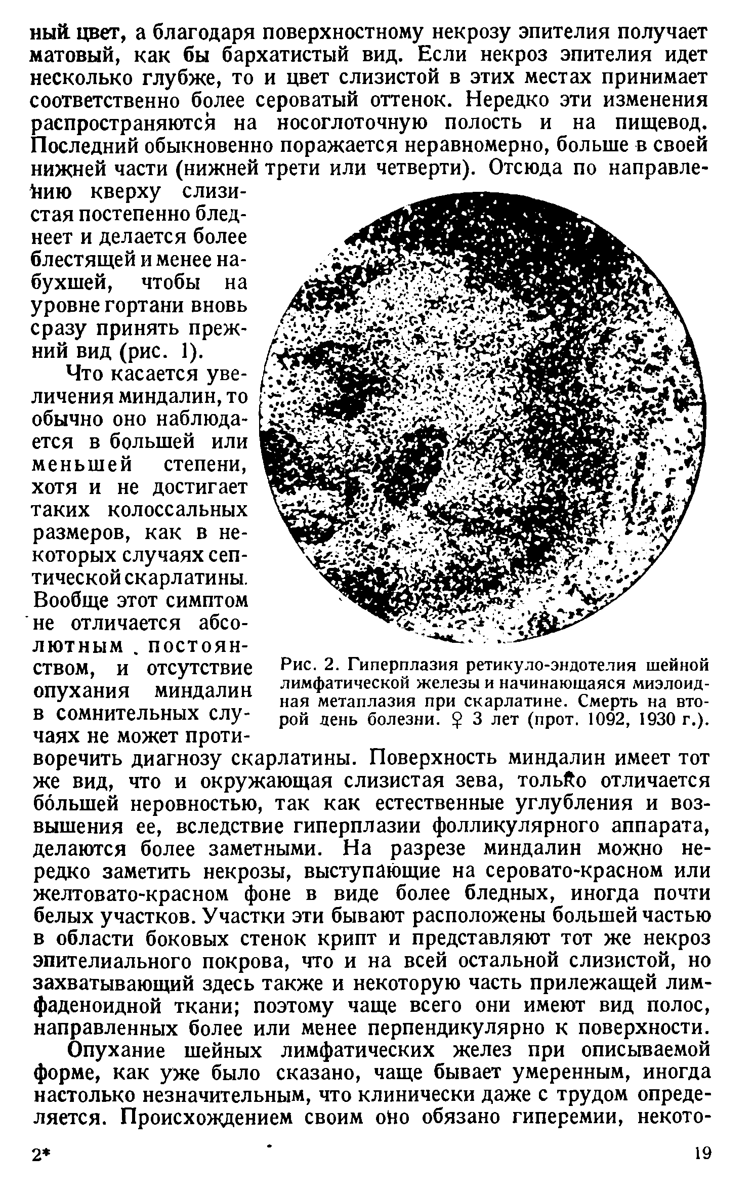 Рис. 2. Гиперплазия ретикуло-эндотелия шейной лимфатической железы и начинающаяся миэлоид-ная метаплазия при скарлатине. Смерть на второй день болезни. 3 лет (прот. 1092, 1930 г.).