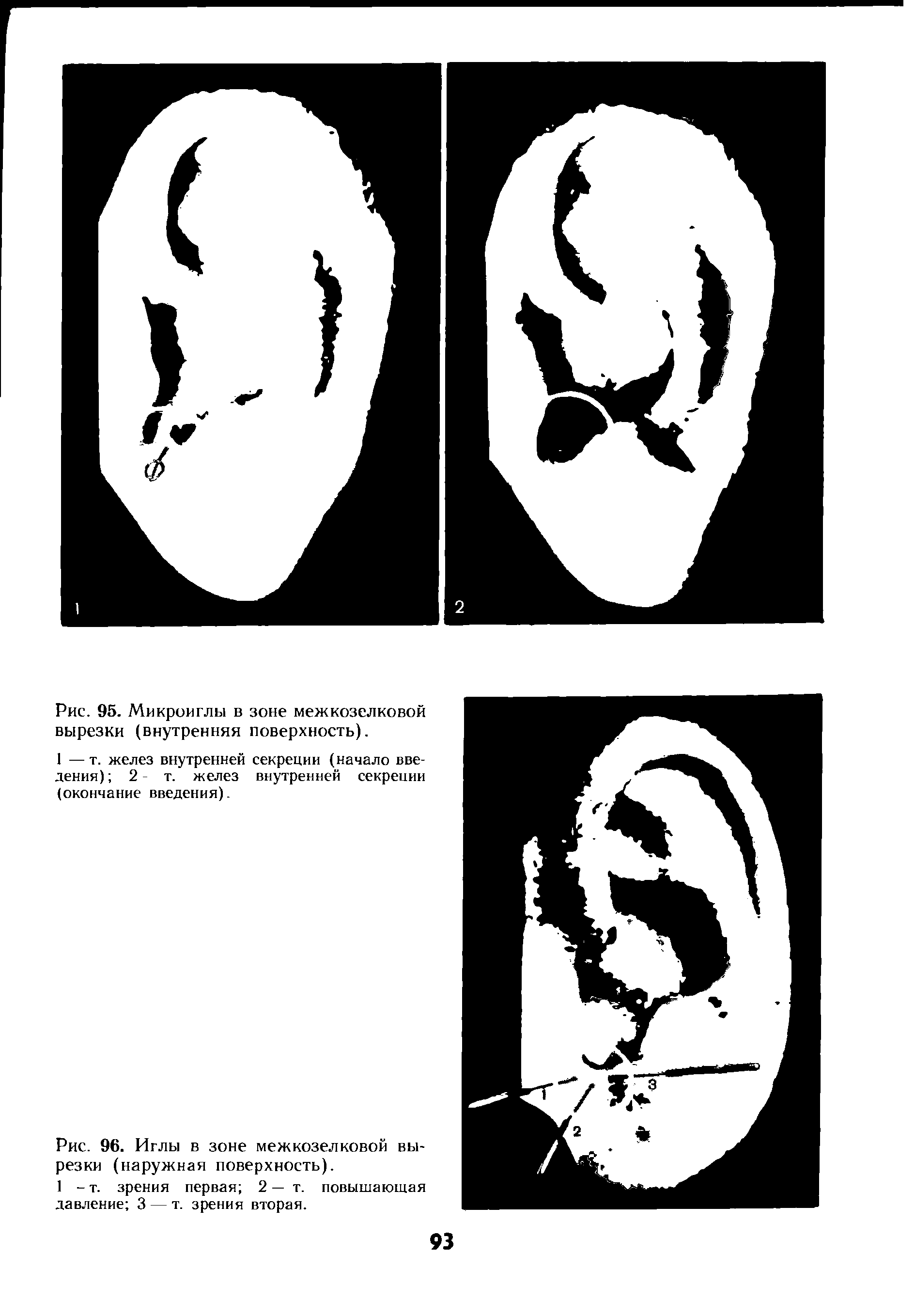 Рис. 96. Иглы в зоне межкозелковой вырезки (наружная поверхность).