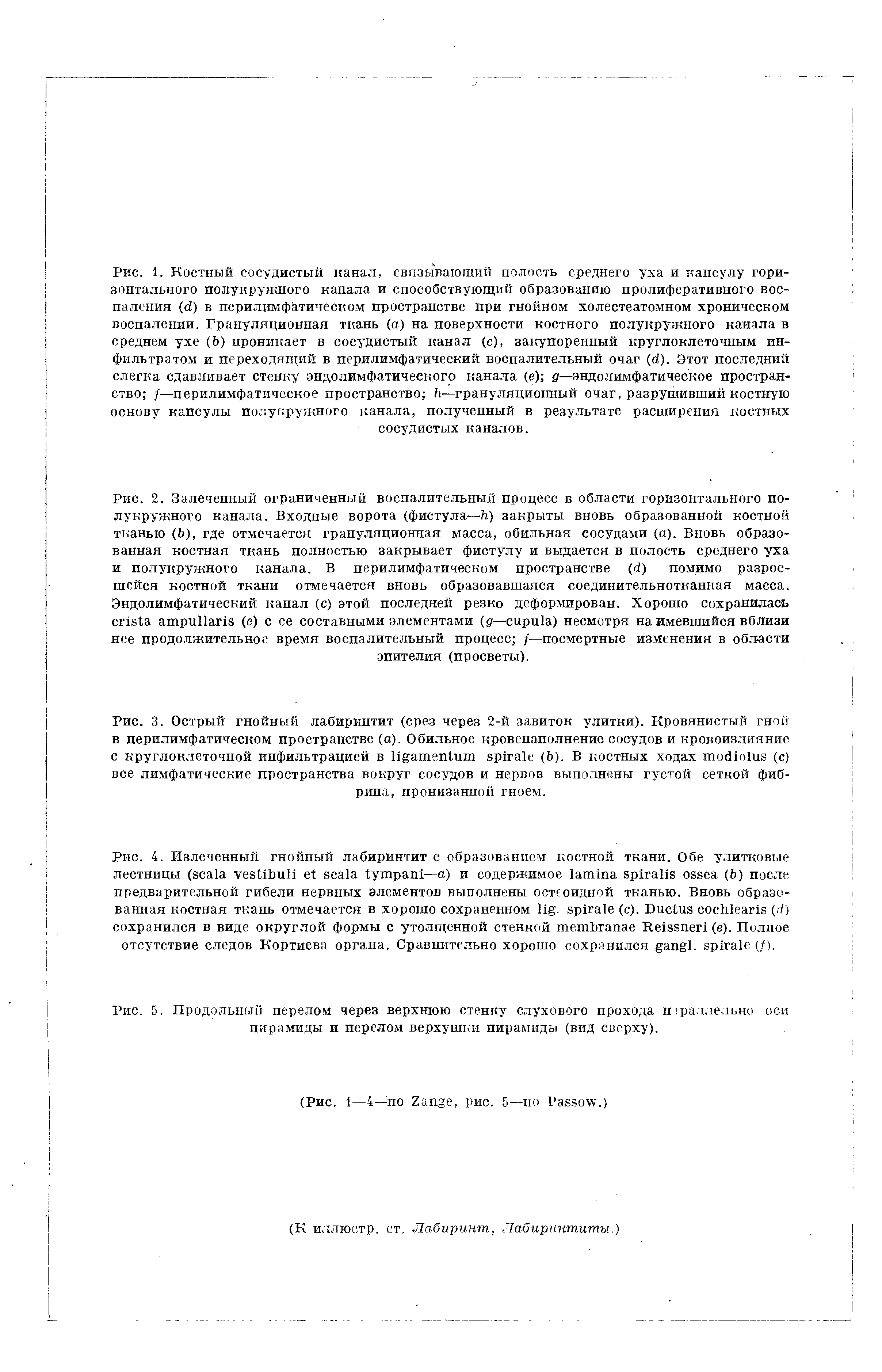 Рис. 5. Продольный перелом через верхнюю стенку слухового прохода шраллельно оси пирамиды и перелом верхушки пирамиды (вид сверху).