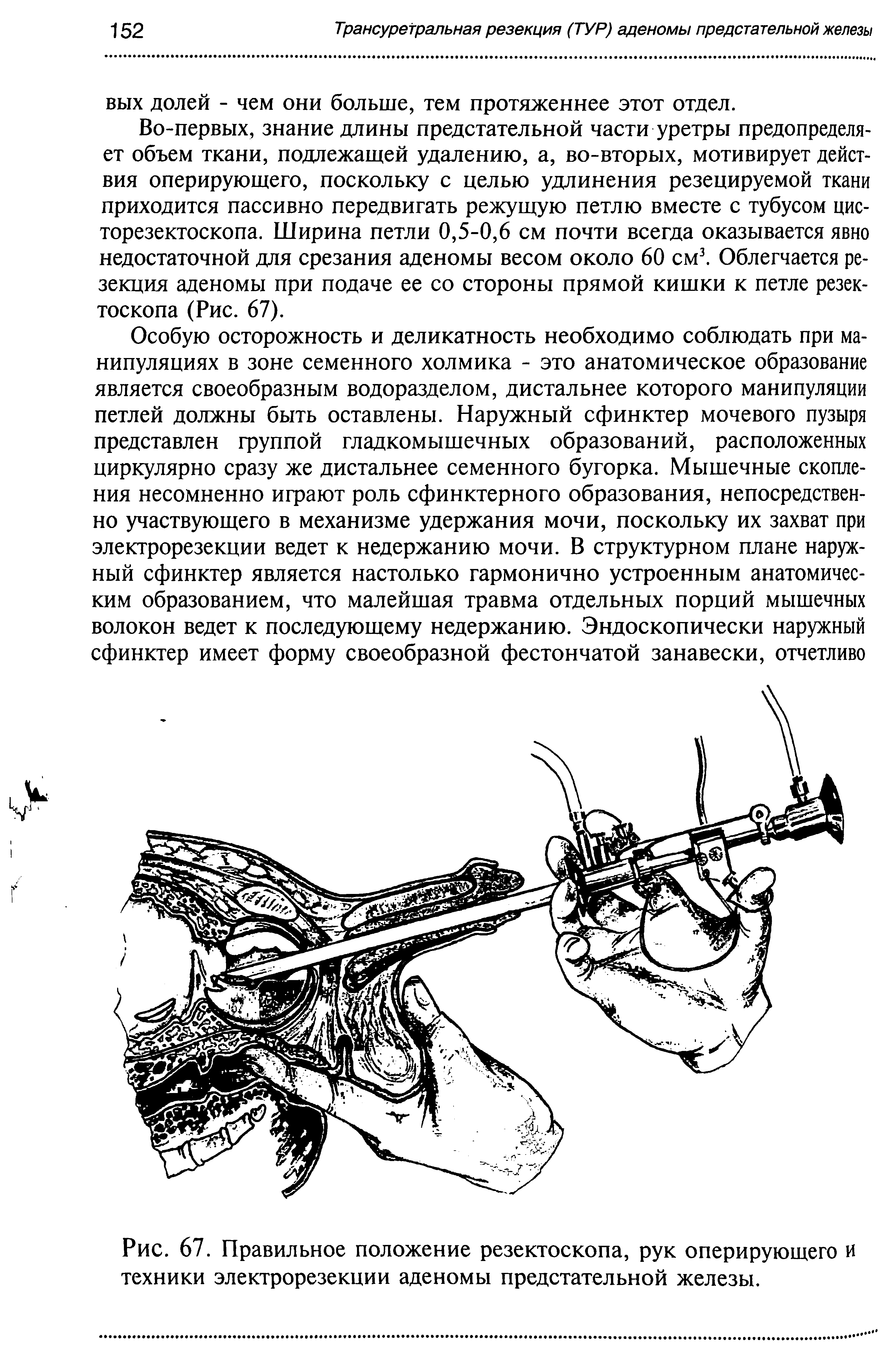 Рис. 67. Правильное положение резектоскопа, рук оперирующего и техники электрорезекции аденомы предстательной железы.