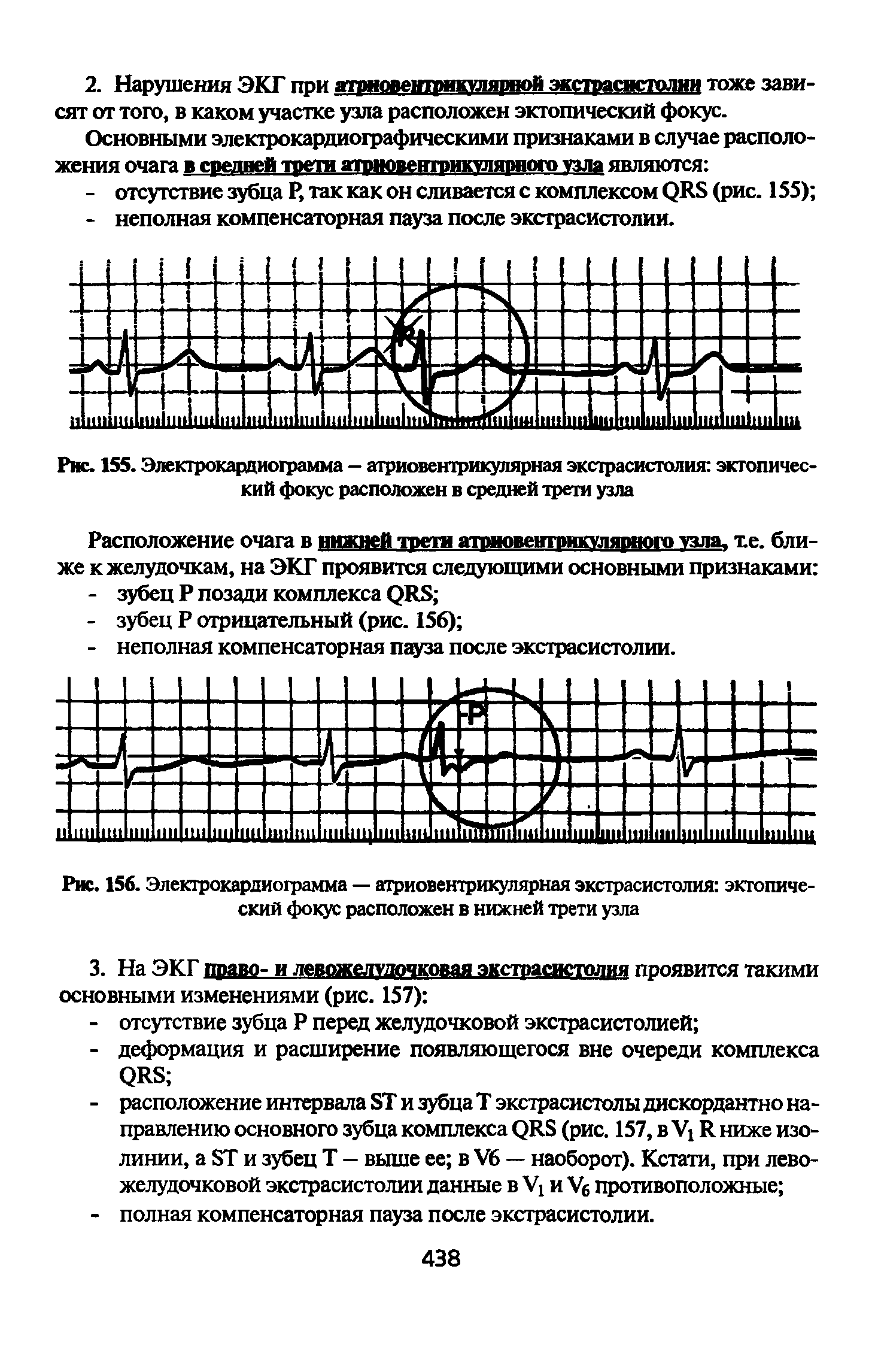 Рис. 1SS. Электрокардиограмма — атриовентрикулярная экстрасистолия эктопический фокус расположен в средней трети узла...