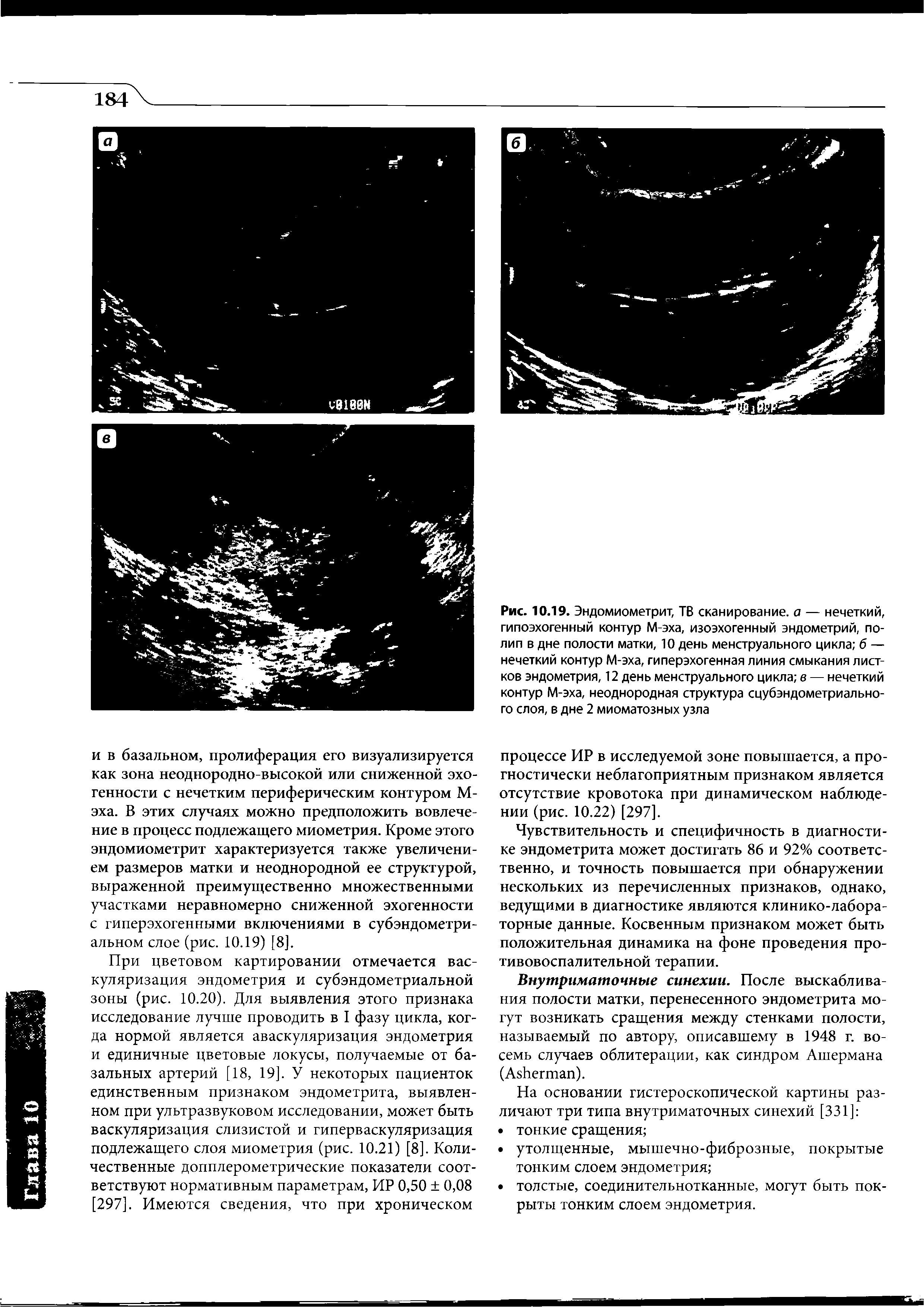 Рис. 10.19. Эндомиометрит, ТВ сканирование, а — нечеткий, гипоэхогенный контур М-эха, изоэхогенный эндометрий, полип в дне полости матки, 10 день менструального цикла б — нечеткий контур М-эха, гиперэхогенная линия смыкания листков эндометрия, 12 день менструального цикла в — нечеткий контур М-эха, неоднородная структура сцубэндометриально-го слоя, в дне 2 миоматозных узла...