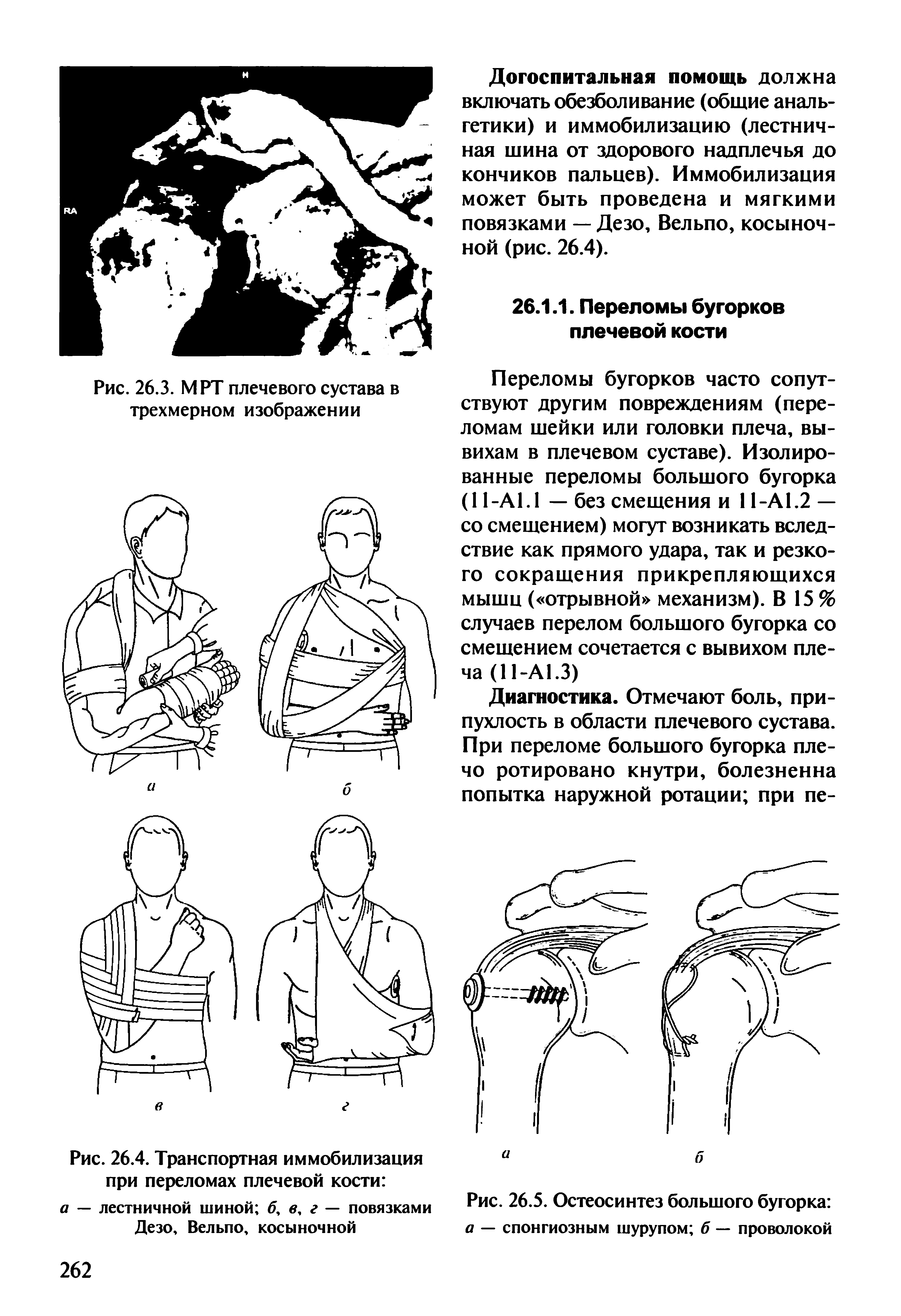 Рис. 26.4. Транспортная иммобилизация при переломах плечевой кости а — лестничной шиной б, в, г — повязками Дезо, Вельпо, косыночной...