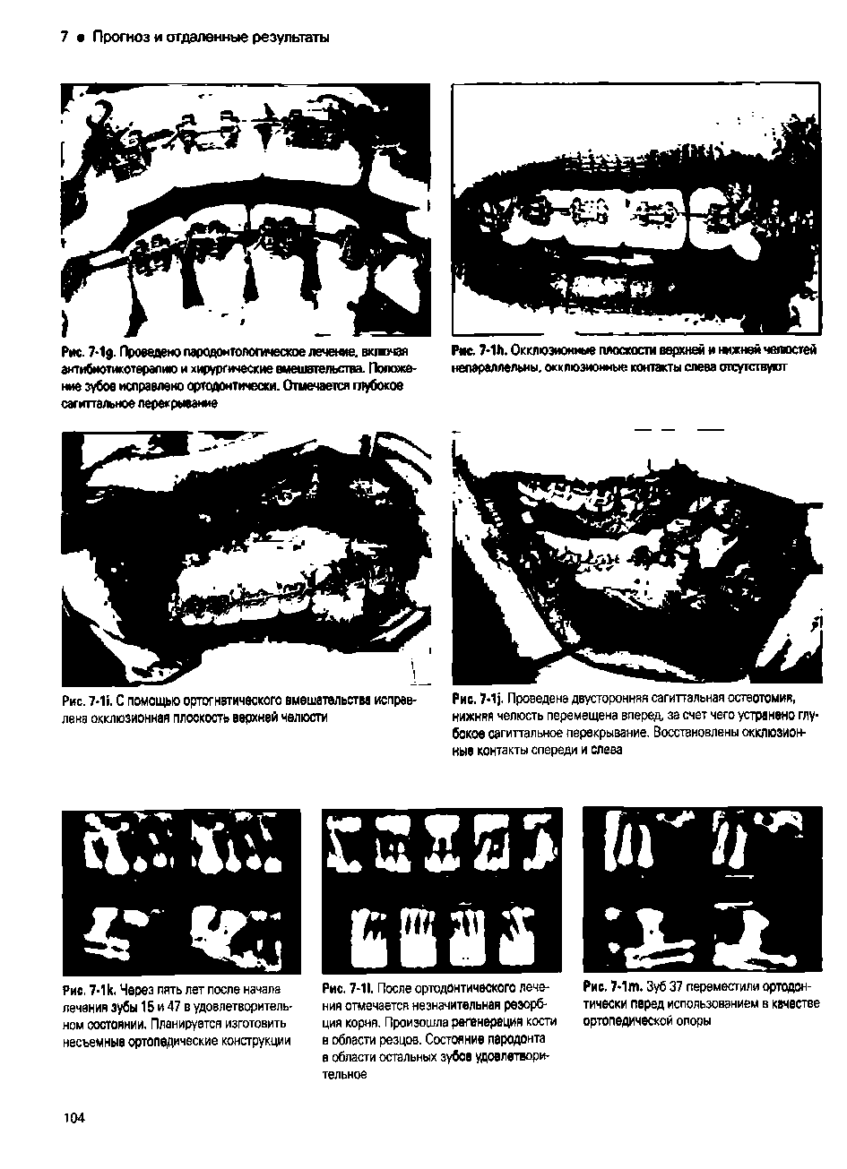 Рис. 7-1 Проведена двусторонняя сагиттальная остеотомия, нижняя челюсть перемещена вперед, за счет чего устранено глубокое сагиттальное перекрывание. Восстановлены окклюзионные контакты спереди и слева...