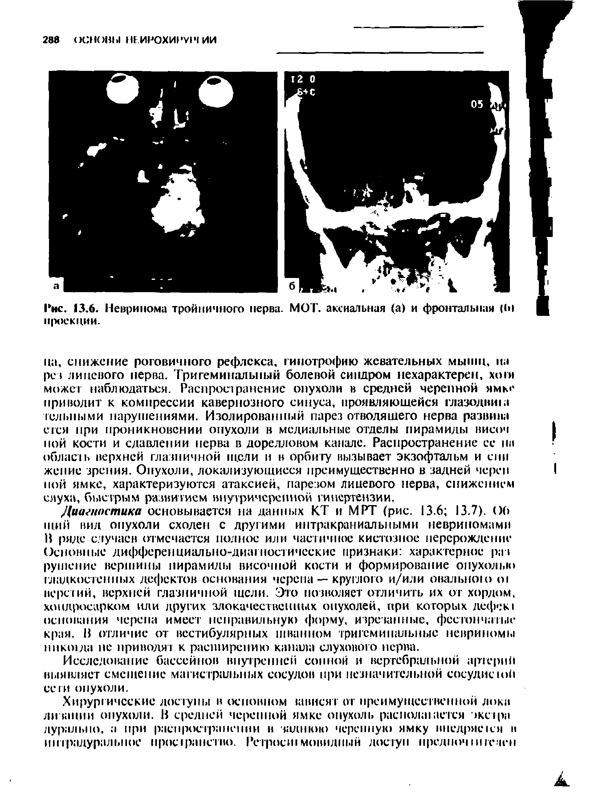 Рис. 13.6. Невринома тройничного нерва. МОТ. аксиальная (а) и фронтальная (( I ПрОСКЦИИ.