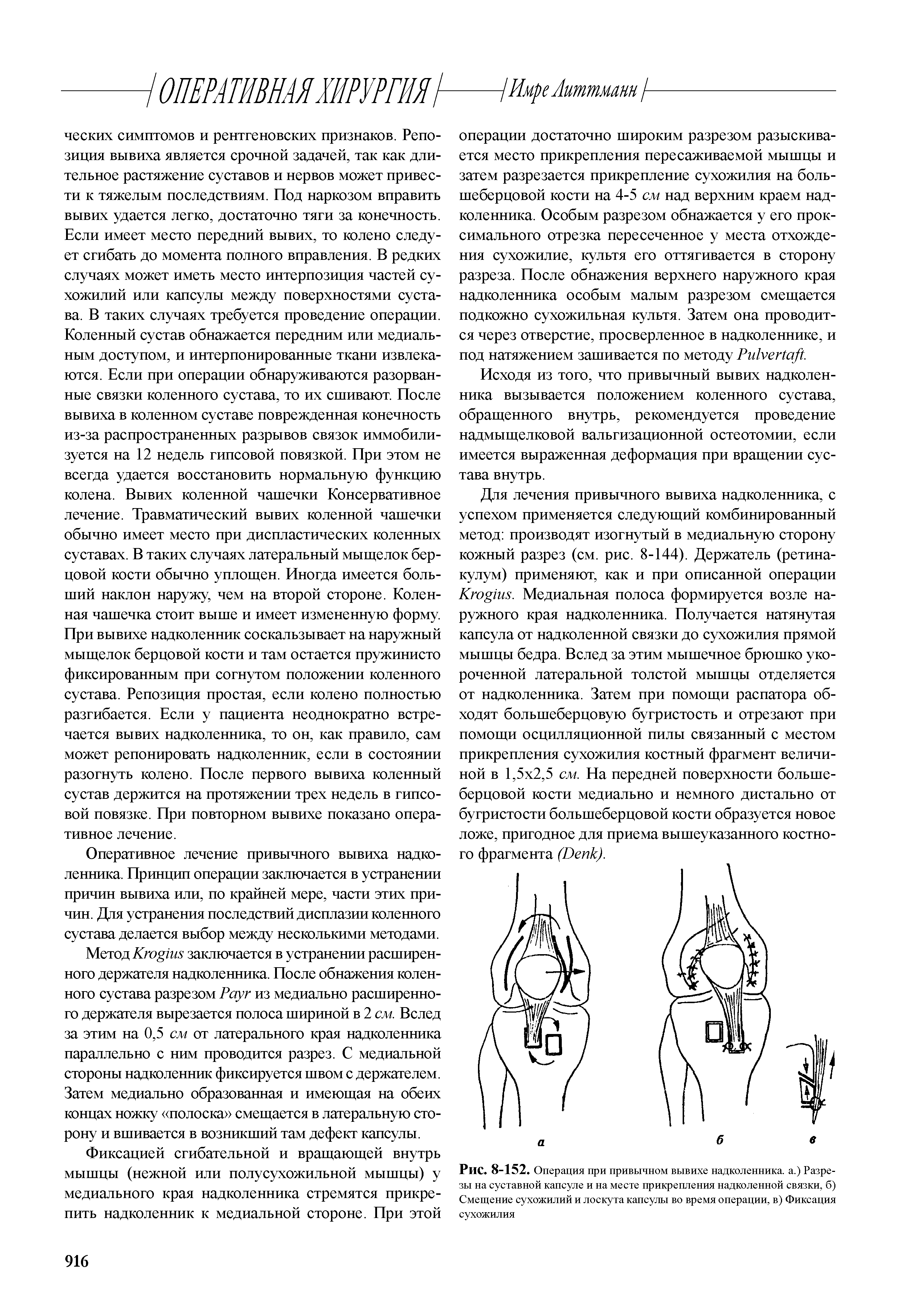 Рис. 8-152. Операция при привычном вывихе надколенника, а.) Разре-зы на суставной капсуле и на месте прикрепления надколенной связки, б) Смещение сухожилий и лоскута капсулы во время операции, в) Фиксация сухожилия...