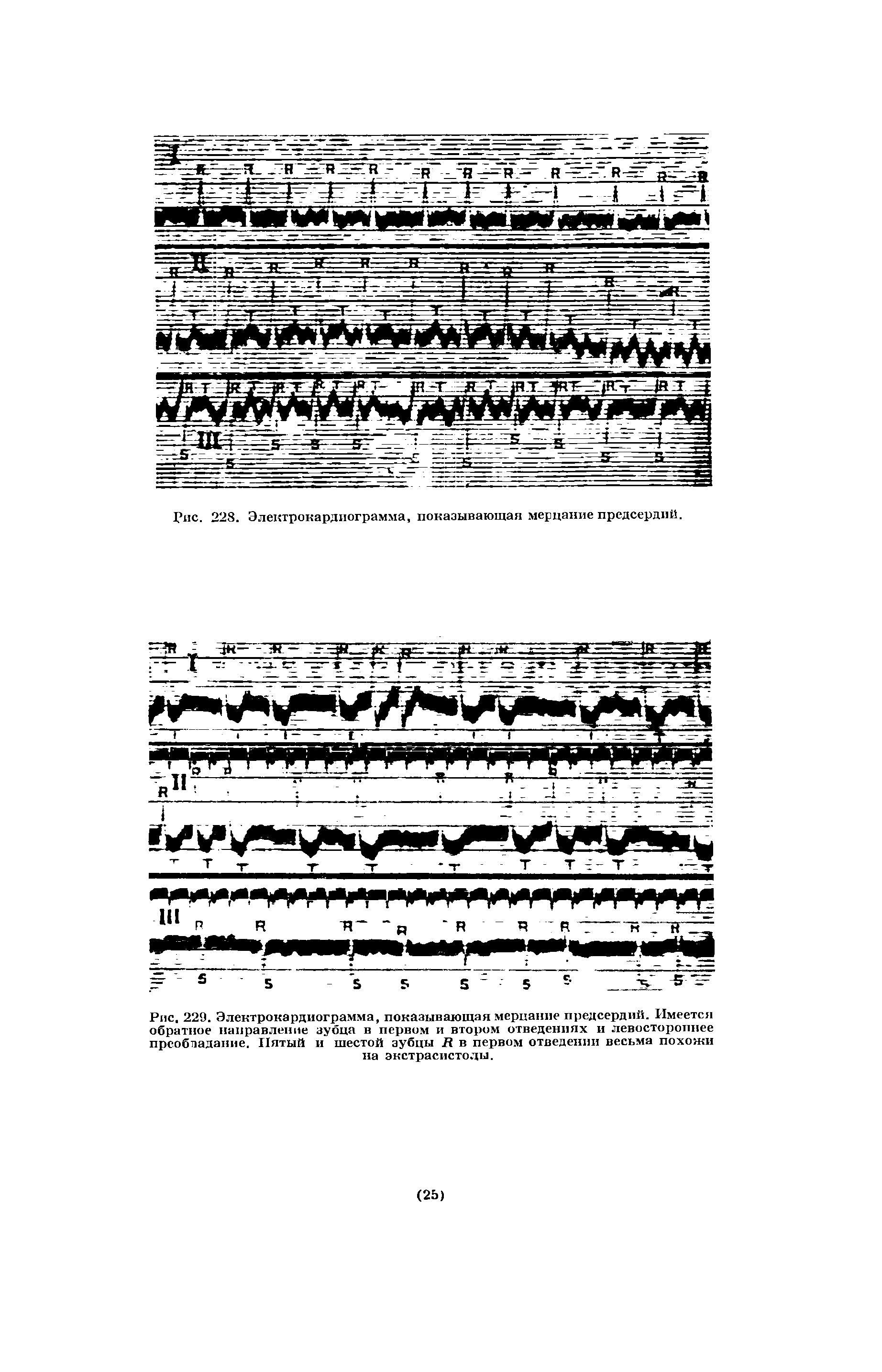 Рис. 229. Электрокардиограмма, показывающая мерцание предсердий. Имеется обратное направление зубца в первом и втором отведениях и левостороннее преобладание. Пятый и шестой зубцы 7 в первом отведении весьма похожи на экстрасистолы.