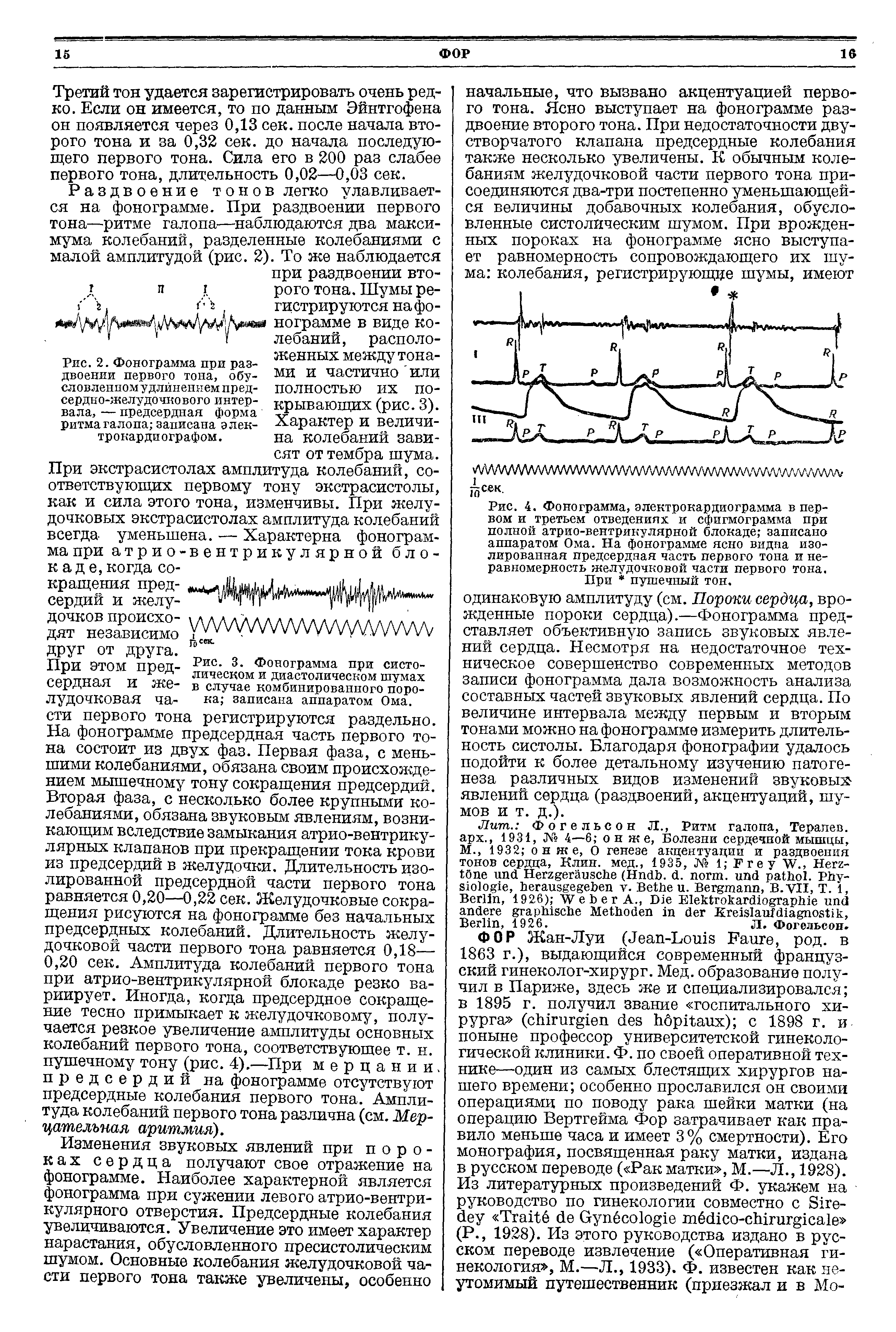 Рис. 4. Фонограмма, электрокардиограмма в первом и третьем отведениях и сфигмограмма при полной атрио-вентрикулярной блокаде записано аппаратом Ома. На фонограмме ясно видна изолированная предсердная часть первого тона и неравномерность желудочковой части первого тона. При пушечный тон.