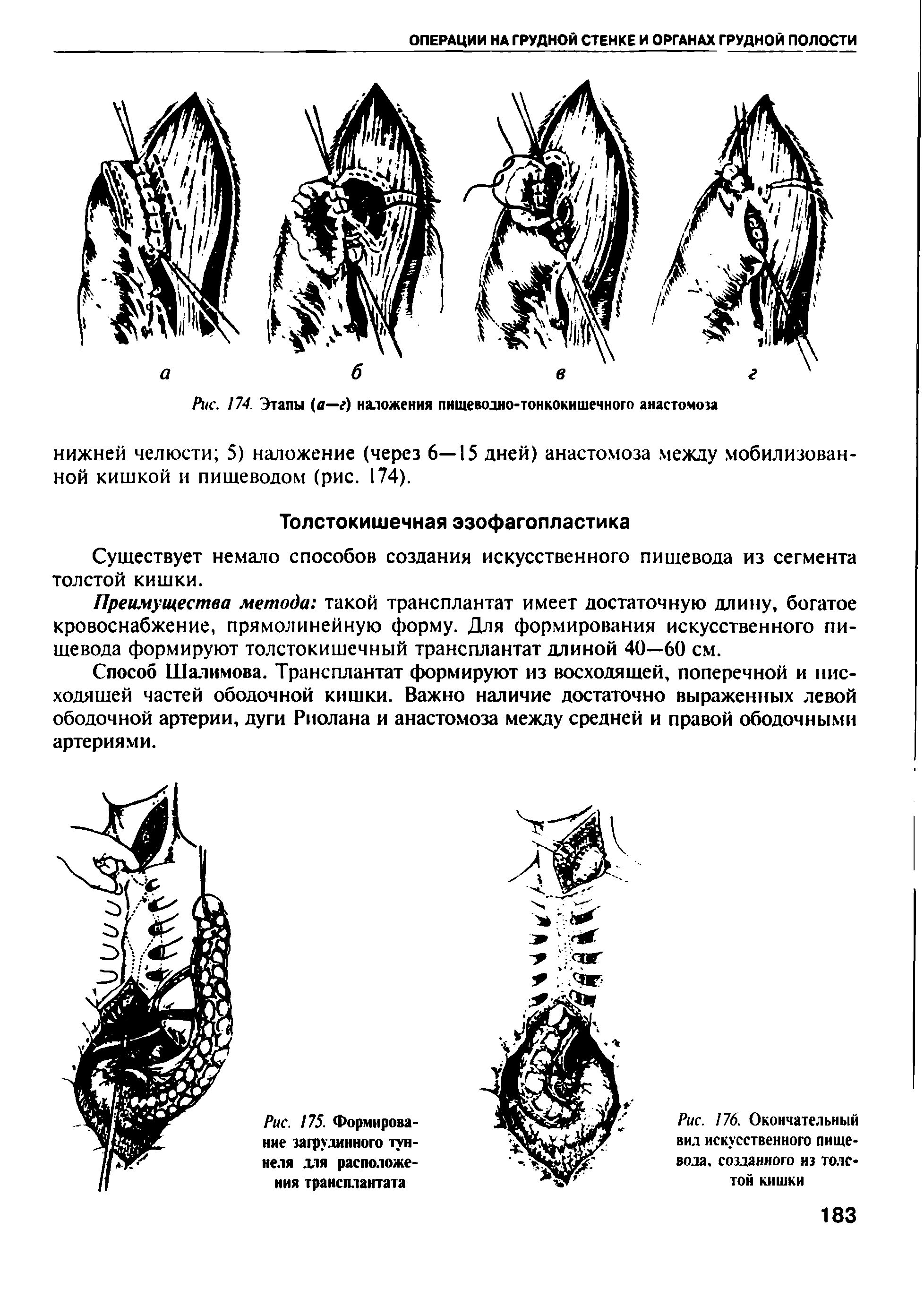 Рис. 176. Окончательный вид искусственного пищевода. созданного из толстой кишки...