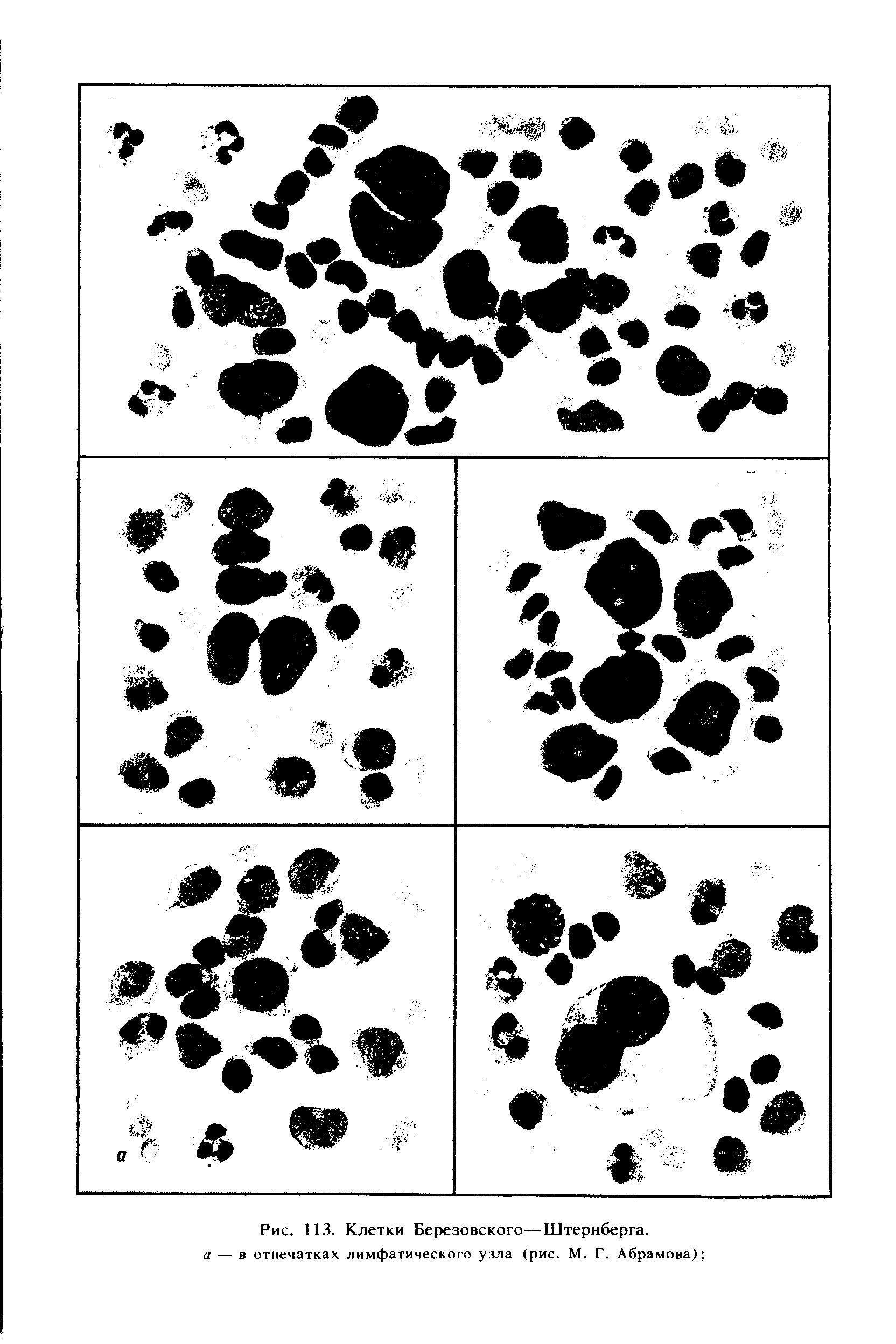 Рис. 113. Клетки Березовского—Штернберга. а — в отпечатках лимфатического узла (рис. М. Г. Абрамова) ...