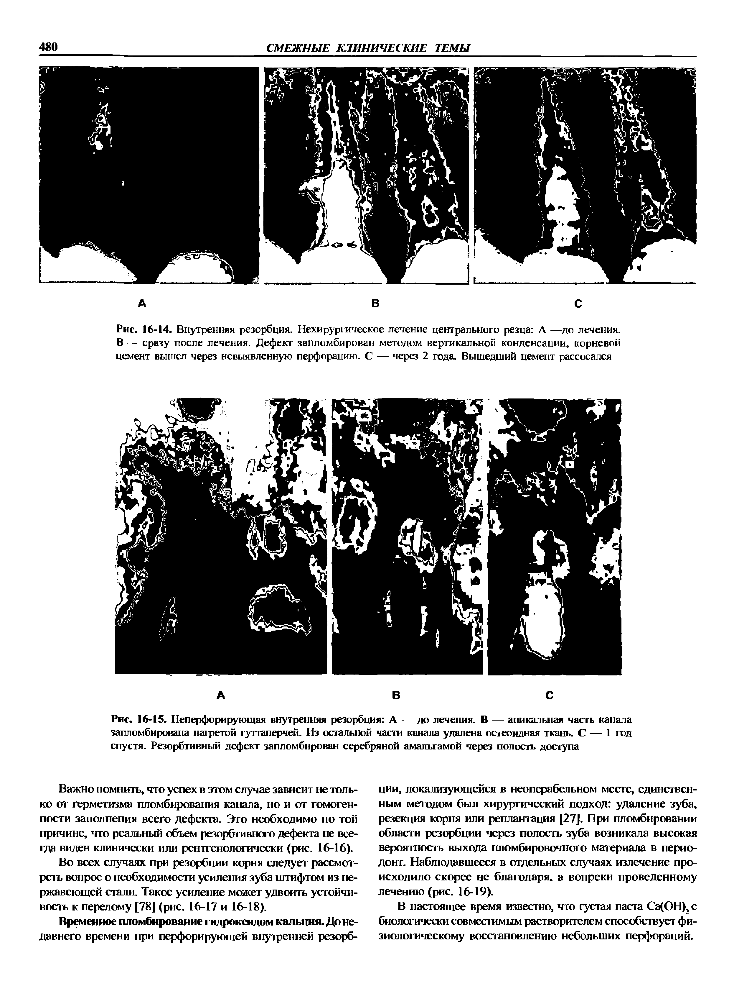 Рис. 16-15. Неперфорирующая внутренняя резорбция А — до лечения. В — апикальная часть канала запломбирована нагретой гуттаперчей. Из остальной части канала удалена остеоидная ткань. С — 1 год спустя. Резорбтивный дефект запломбирован серебряной амальгамой через полость доступа...