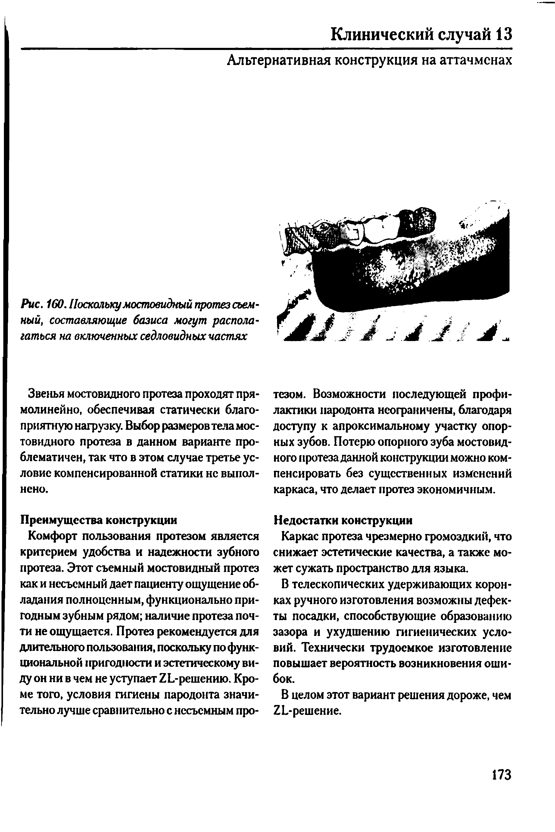 Рис. 160. Поскольку мостовидный протез съемный, составляющие базиса могут располагаться на включенных седловидных частях...