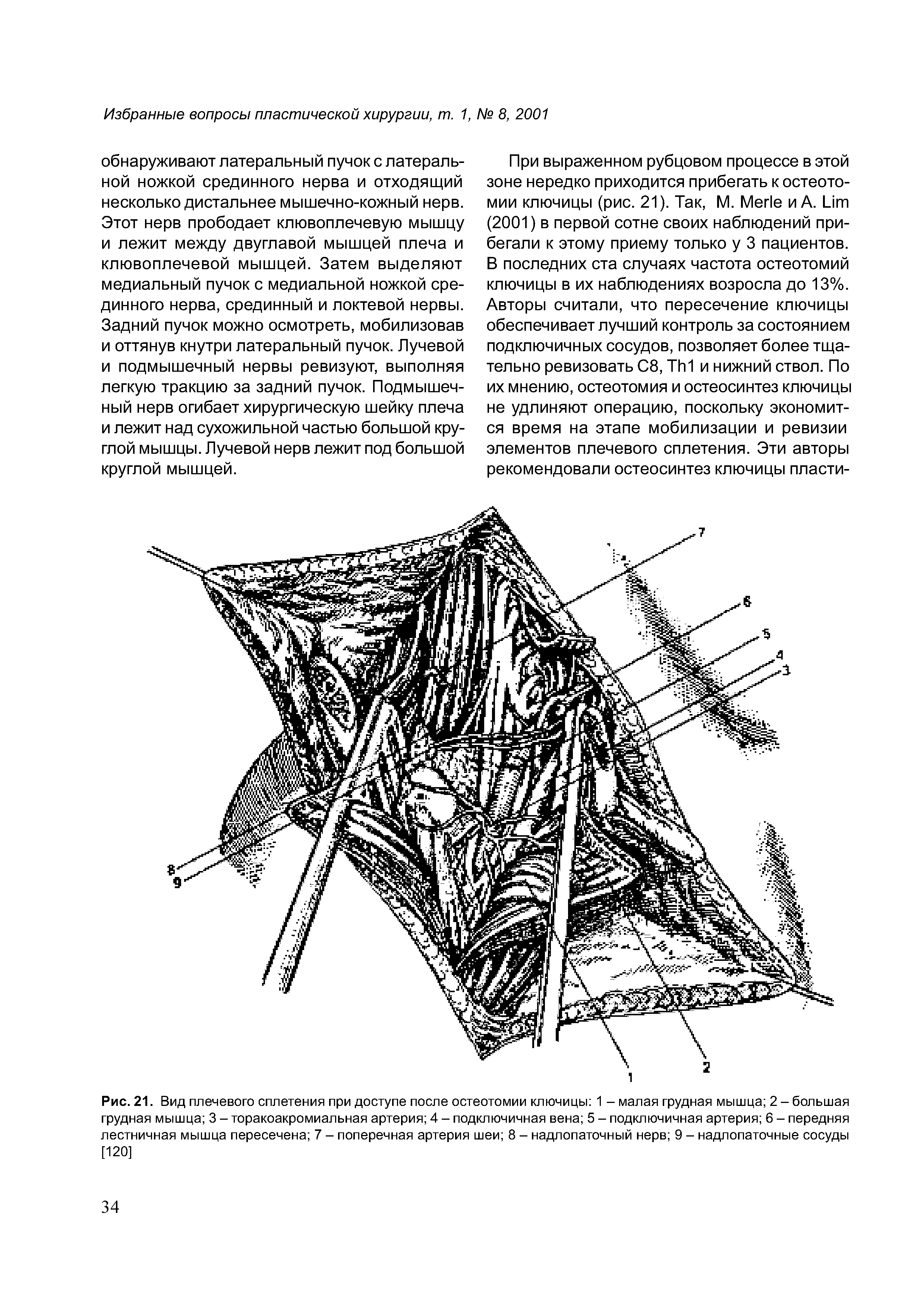 Рис. 21. Вид плечевого сплетения при доступе после остеотомии ключицы 1 - малая грудная мышца 2 - большая грудная мышца 3 - торакоакромиальная артерия 4 - подключичная вена 5 - подключичная артерия 6 - передняя лестничная мышца пересечена 7 - поперечная артерия шеи 8 - надлопаточный нерв 9 - надлопаточные сосуды [120]...