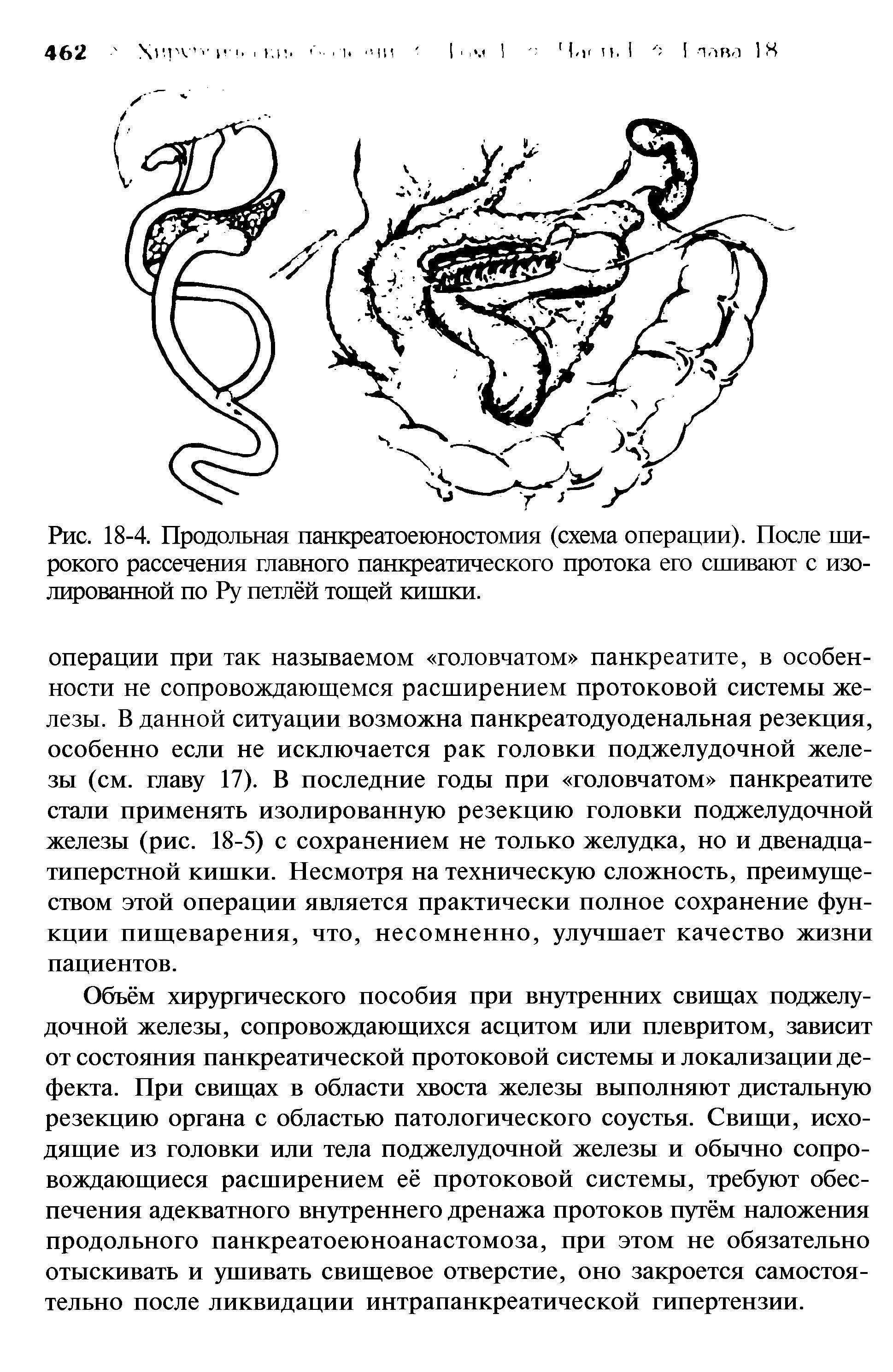 Рис. 18-4. Продольная панкреатоеюностомия (схема операции). После широкого рассечения главного панкреатического протока его сшивают с изолированной по Ру петлёй тощей кишки.