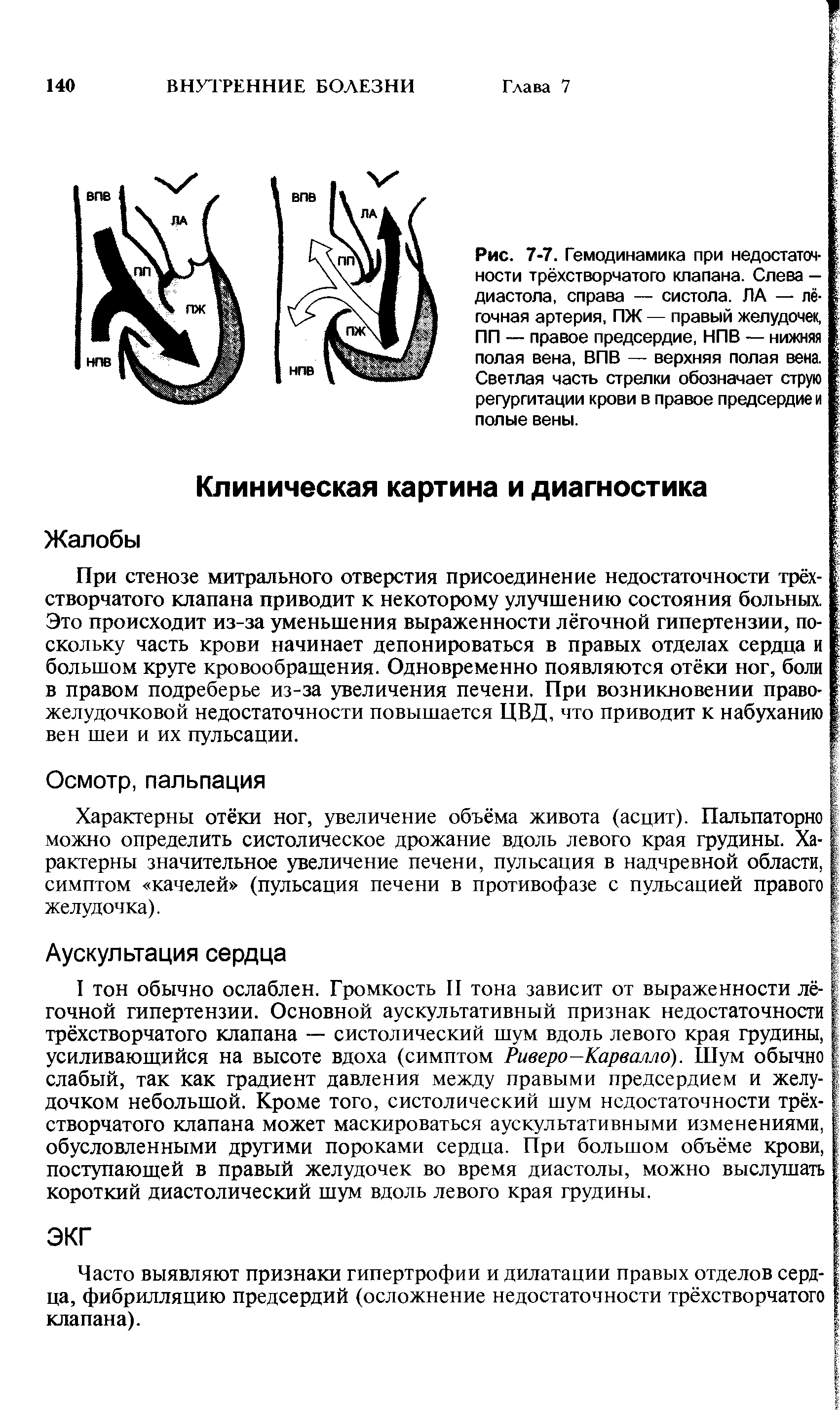 Рис. 7-7. Гемодинамика при недостаточности трёхстворчатого клапана. Слева — диастола, справа — систола. ЛА — лёгочная артерия, ПЖ — правый желудочек, ПП — правое предсердие, НПВ — нижняя полая вена, ВИВ — верхняя полая вена. Светлая часть стрелки обозначает струю регургитации крови в правое предсердие и полые вены.