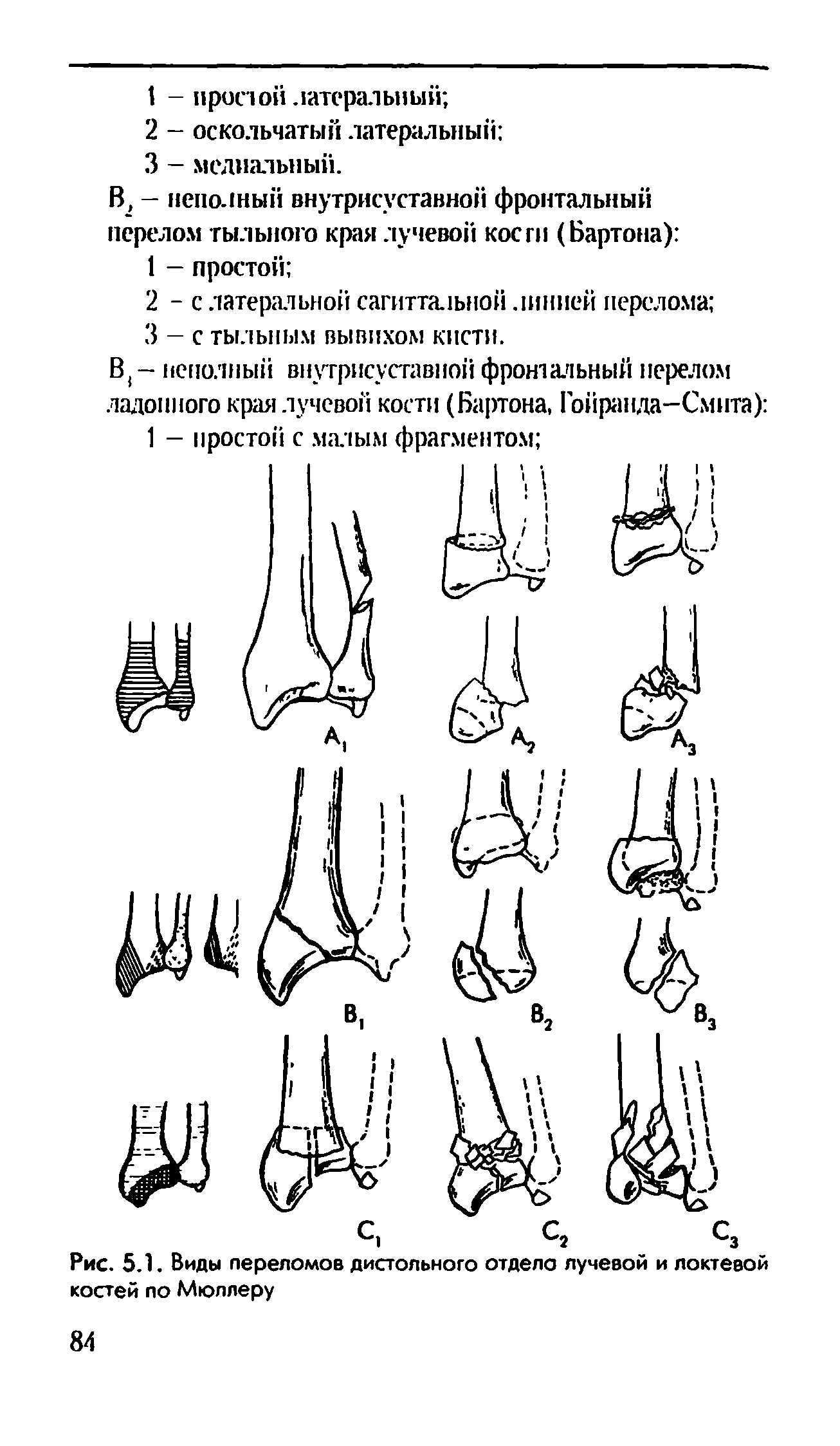 Рис. 5.1. Виды переломов дистального отдело лучевой и локтевой костей по Мюллеру...