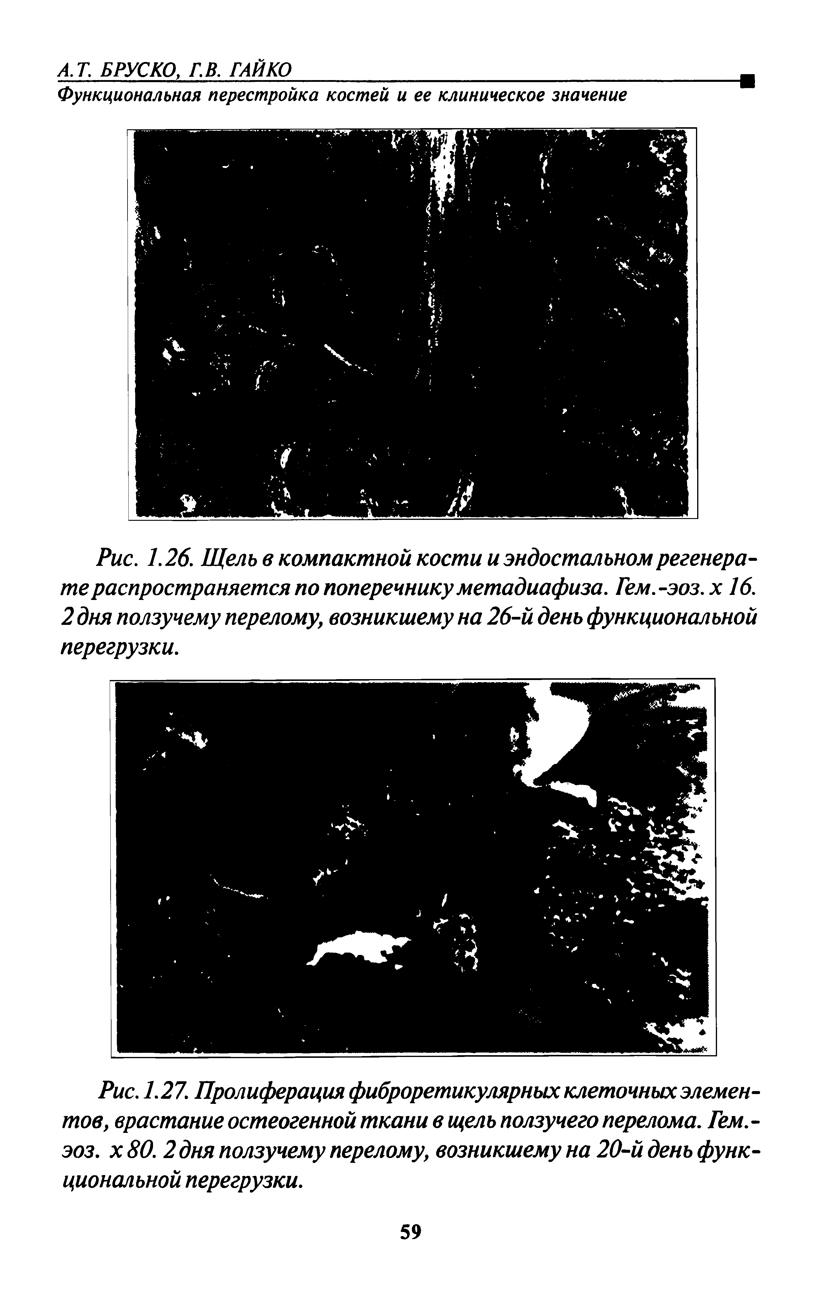 Рис. 1.26. Щель в компактной кости и эндостальном регенерате распространяется по поперечнику метадиафиза. Гем.-эоз.х 16. 2 дня ползучему перелому, возникшему на 26-й день функциональной перегрузки.