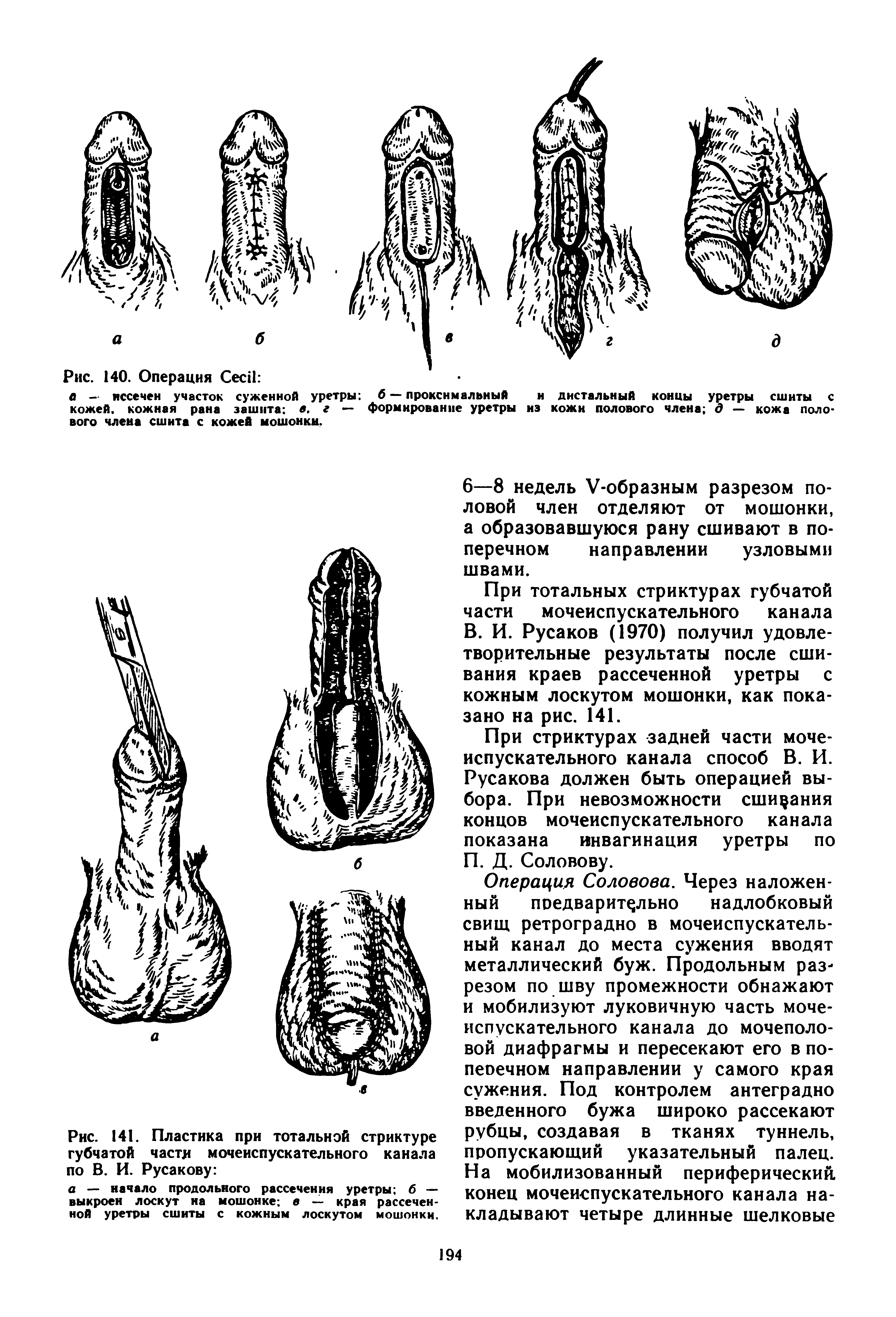Рис. 141. Пластика при тотальной стриктуре губчатой части мочеиспускательного канала по В. И. Русакову ...