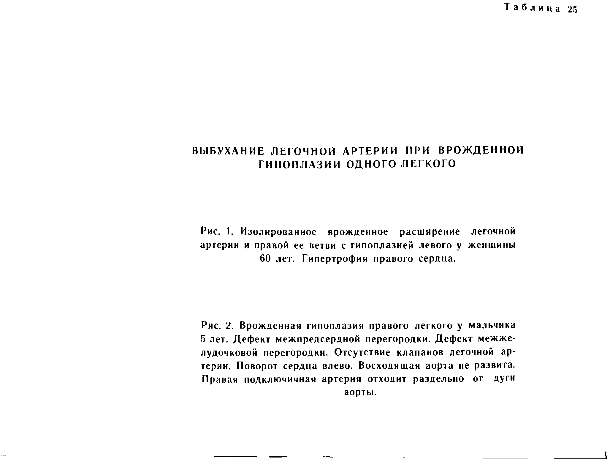 Рис. 2. Врожденная гипоплазия правого легкого у мальчика 5 лет. Дефект межпредсердной перегородки. Дефект межжелудочковой перегородки. Отсутствие клапанов легочной артерии. Поворот сердца влево. Восходящая аорта не развита. Правая подключичная артерия отходит раздельно от дуги аорты.