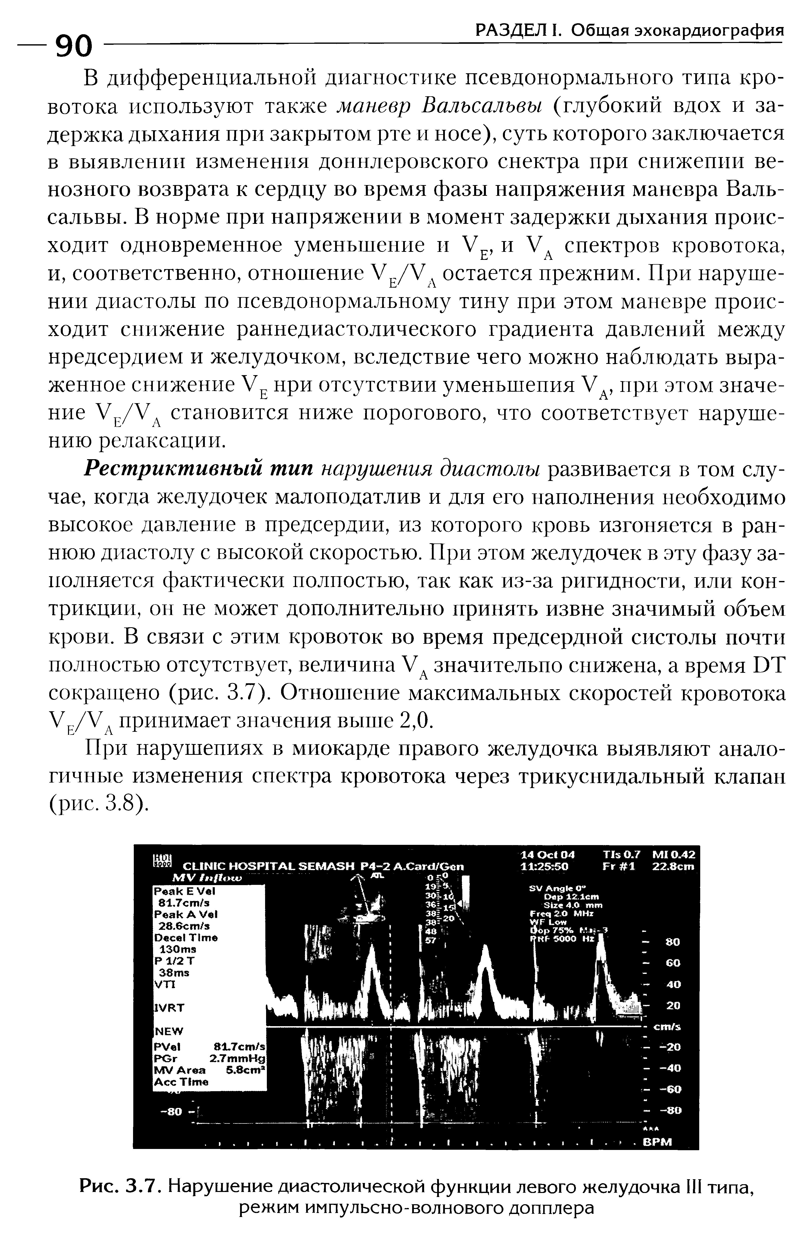 Рис. 3.7. Нарушение диастолической функции левого желудочка III типа, режим импульсно-волнового допплера...