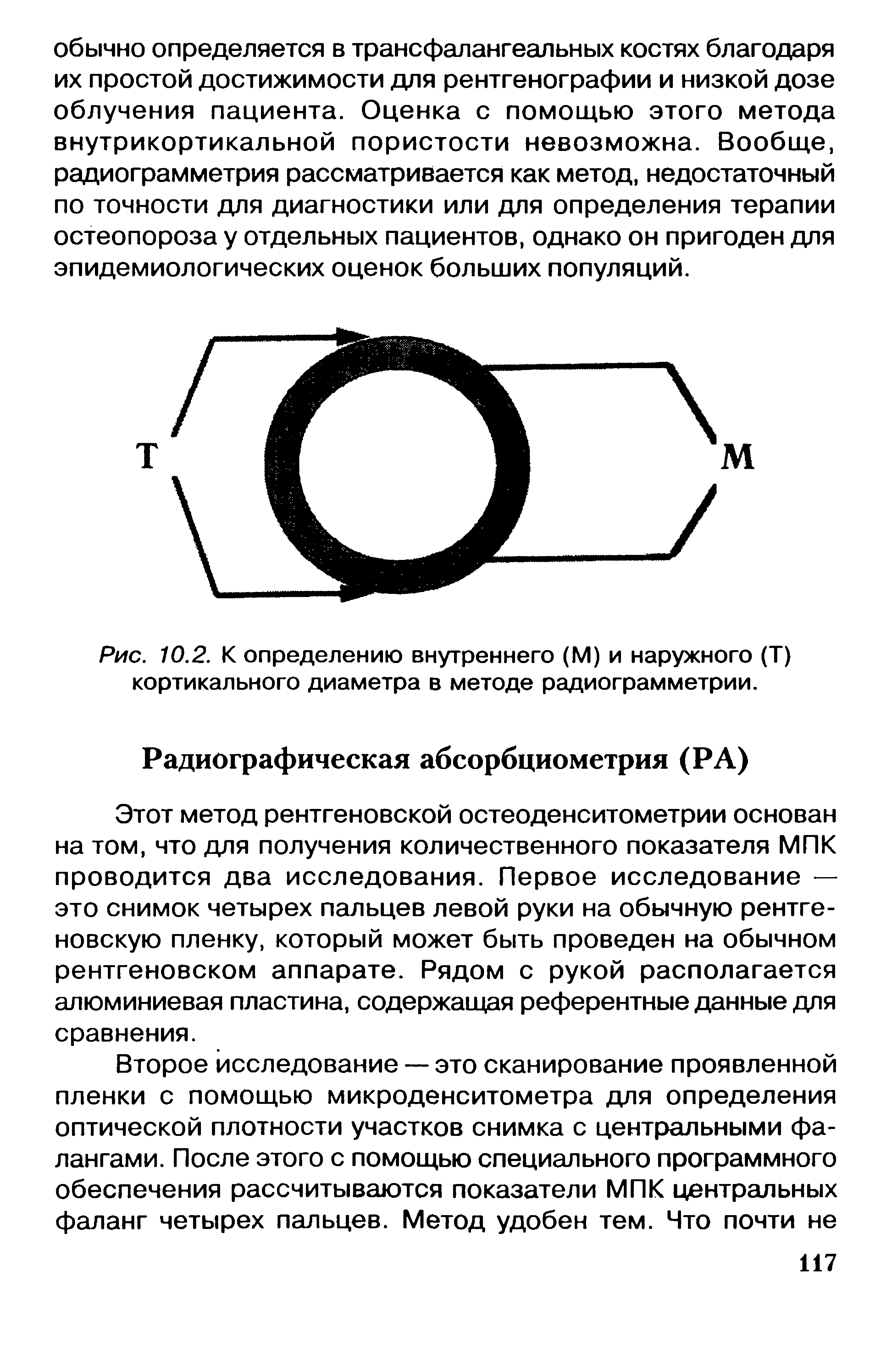 Рис. 10.2. К определению внутреннего (М) и наружного (Т) кортикального диаметра в методе радиограмметрии.