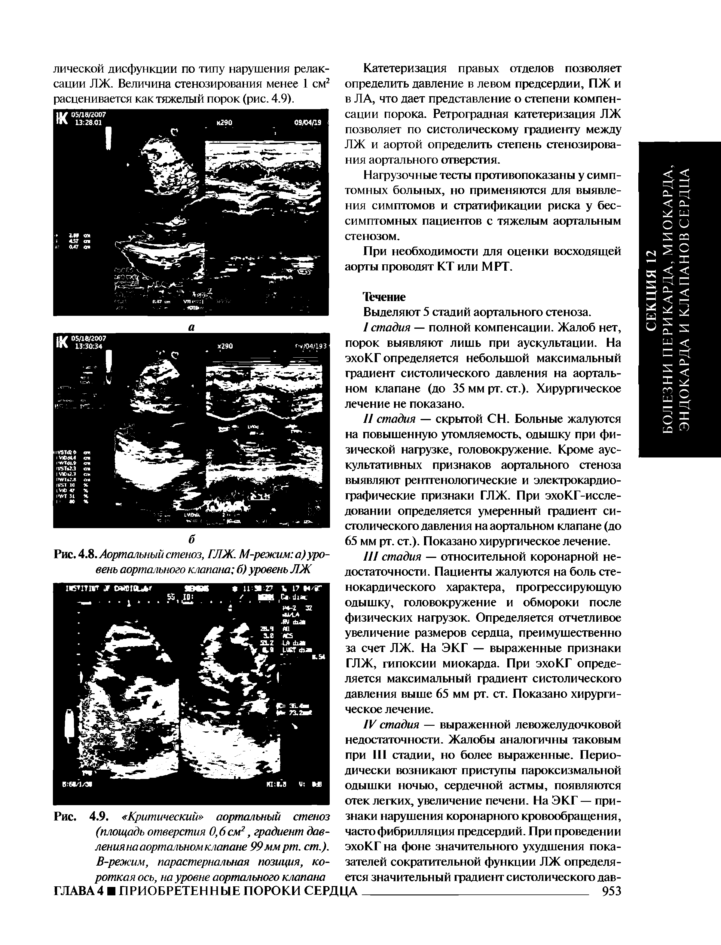 Рис. 4.9. Критический аортальный стеноз (площадь отверстия 0,6 см2, градиент давления на аортальном клапане 99 мм рт. ст.). В-режим, парастернальная позиция, ко-...