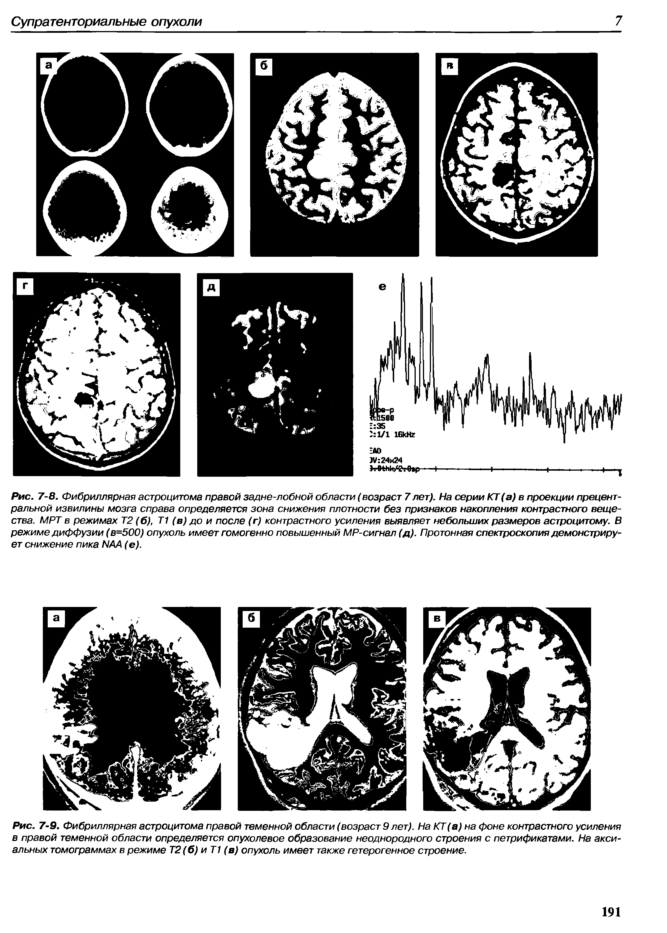 Рис. 7-9. Фибриллярная астроцитома правой теменной области (возраст 9 лет). На КТ (а) на фоне контрастного усиления в правой теменной области определяется опухолевое образование неоднородного строения с петрификатами. На аксиальных томограммах в режиме Т2 (б) и Т1 (в) опухоль имеет также гетерогенное строение.