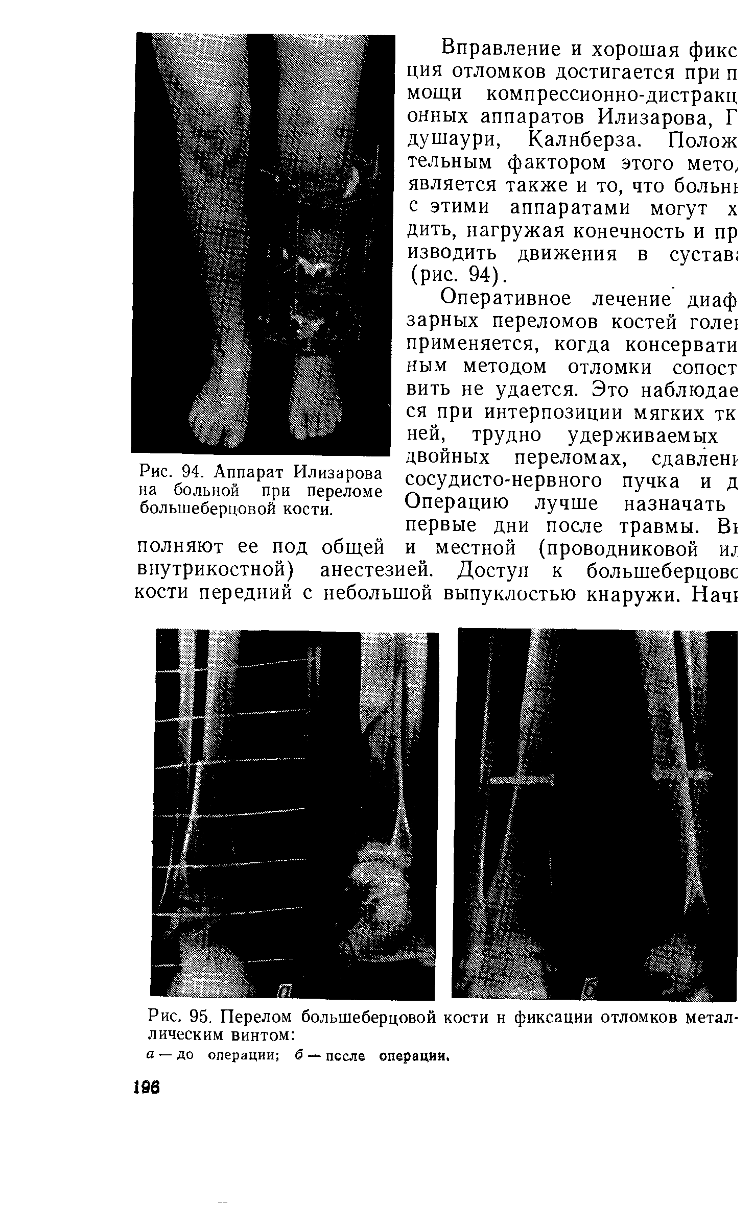 Рис. 95 Перелом большеберцовой кости н фиксации отломков металлическим винтом ...