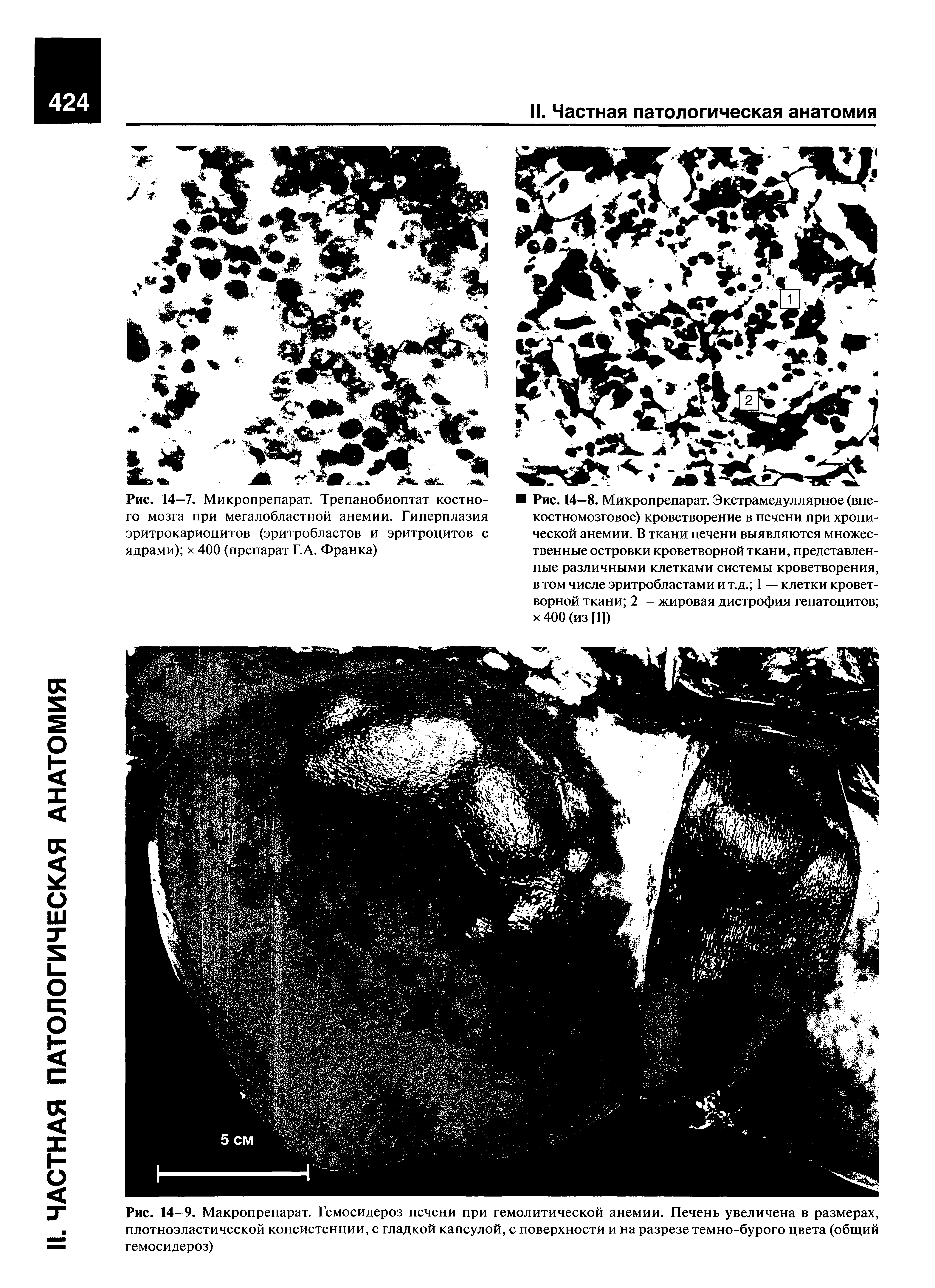 Рис. 14-9. Макропрепарат. Гемосидероз печени при гемолитической анемии. Печень увеличена в размерах, плотноэластической консистенции, с гладкой капсулой, с поверхности и на разрезе темно-бурого цвета (общий гемосидероз)...